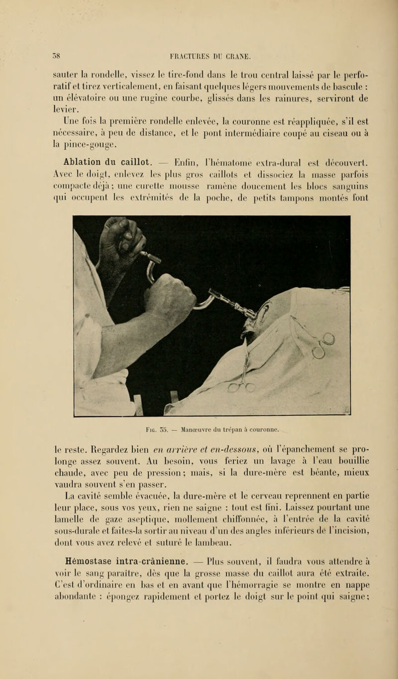 sauter la rondelle, vissez le tire-fond dans le trou central laissé par le perfo- ratif et tirez verticalement, en faisant quelques légers mouvements de bascule : un élévatoire ou une rugine courbe, lissés dans les rainures, serviront de levier. Une fois la première rondelle enlevée, la couronne est réappliquée, s'il est nécessaire, à peu de distance, et le pont intermédiaire coupé au ciseau ou à la pince-gouge. Ablation du caillot. - - Enfin, l'hémati i extra-dural est découvert. Avec le doigt, enlevez les plus gros caillots et dissociez la unisse parfois compacte déjà ; une curette mousse ramène doucement les blocs sanguins qui occupent les extrémités de la poche, de petits tampons montés l'ont ^\J 1 Pi # ! w --m * < 12 mt f~yr Fie. 35. — Manœuvre du trépan ;i couronne. le reste. Regardez bien en arrière et en-dessous, où l'épanchement se pro- longe assez souvent. Au besoin, vous feriez un lavage à l'eau bouillie chaude, avec peu de pression; mais, si la dure-mère est béante, mieux vaudra souvent s'en passer. La cavité semble évacuée, la dure-mère et le cerveau reprennent en partie leur place, sous vos yeux, rien ne saigne : tout est fini, baissez pourtant une lamelle de gaze aseptique, mollement chiffonnée, à l'entrée de la cavité sous-durale et faites-la sortir au niveau d'un des angles inférieurs dé I incision, dont vous avez relevé cl suturé le lambeau. Hémostase intra-crânienne. —Plus souvent, il faudra vous attendre à voir le sang paraître, dès que la grosse masse du caillot aura élé extraite. C'esl d'ordinaire en bas et en avant que l'hémorragie se montre en nappe abondante : épongez rapidement et portez le doigt sur le point qui saigne;