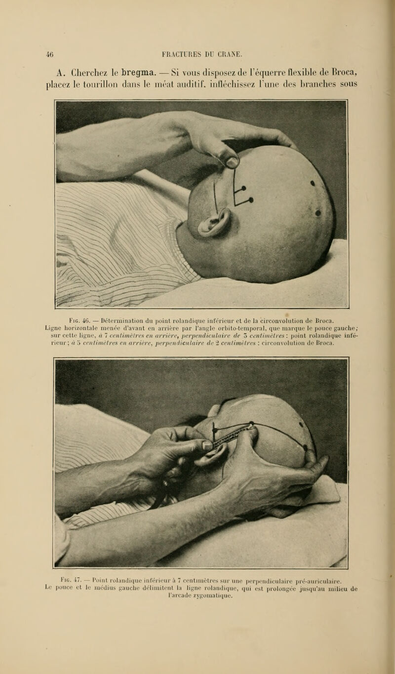 A. Cherchez le bregma. —Si vous disposezde l'équerre flexible de Broea, placez le tourillon dans le méat auditif, infléchissez l'une des branches suus Fig, 46. — Détermination du point rolandique inférieur et de la circonvolution de Broca. Ligne horizontale menée d'avant en arrière par l'angle orbito-temporal, que marque le pouce gauche; sur cette ligne, n 7 centimètres en arrière, perpendiculaire de ô centimètres: point rolandique inté- rieur; n .'» centimètres -■// arrière, perpendiculaire d<- - centimètres : circonvolution de Broea. 1 • '■ Poinl roi lique inférieur a 7 centimètres sur une perpendiculaire pré-auriculaire. '•'■ I ''' et le médius gauche dél tenl la ligne rolandique, ijni esl prolongée jusqu'au milieu de l'arcade zygomatîque.