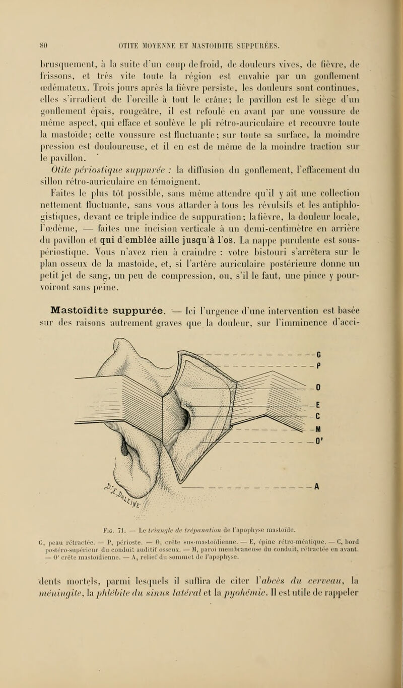 brusquement, à 1 ; i suite d'un coup de froid, dedouleurs vives, de Bèvre, de frissons, et très vite toute la région est envahie par un gonflemenl œdémateux. Trois juins après la fièvre persiste, les douleurs sont continues, elles s'irradient de l'oreille à toul le crâne; le pavillon est le siège d'un gonflemenl épais, rougeâtre, il est refoulé en avant par une voussure de même aspect, qui efface et soulève le pli rétro-auriculaire et recouvre toute la mastoïde; cette voussure est fluctuante ; sur toute sa surface, la moindre pression est douloureuse, et il en est de même de la moindre traction sur le pavillon. Otite përiostique suppurée : la diffusion du gonflement, l'effacement du sillon rétro-auriculaire en témoignent. Faites le plus tôt pos'sible, sans même attendre qu'il y ait une collection nettement fluctuante, sans vous attarder à tous les révulsifs et les antiphlo- gistiques, devant ce triple indice de suppurai ion; la lièvre, la douleur locale. l'œdème, — faites une incision verticale à un demi-centimètre en arrière du pavillon et qui d'emblée aille jusqu'à l'os. La nappe purulente est sous- périostique. Vous n'avez rien à craindre : votre bistouri s'arrêtera sur le plan osseux de la mastoïde, et, si l'artère auriculaire postérieure donne un petit jet de sang, un peu de compression, ou, s'il le faut, une pince y pour- voiront sans peine. Mastoïdite suppurée. — Ici l'urgence d'une intervention est basée sur des raisons autrement graves que la douleur, sur l'imminence d acci- Fic. 71. — Le triangle tl<- trépanation de l'apophyse mastoïde. G, peau rétractée.— P, périoste. — 0, crête sus-mastoïdienne.— E, épine rétro-méalique. — C, bord postéro-supérieur du conduit auditif osseux. — M, paroi membraneuse du conduit, rétractée en ayant. — o' crête mastoïdienne. — A, relief du sommet de l'apophyse. dents mortels, parmi lesquels il suffira île citer l abcès du cerveau, la méningite, la phlébite du sinus latéral et la pyohémie. Il est utile de rappeler