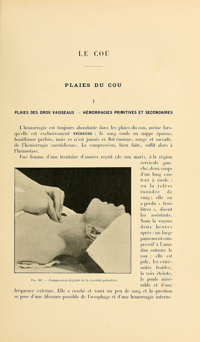 LE COU PLAIES DU COU PLAIES DES GROS VAISSEAUX — HÉMORRAGIES PRIMITIVES ET SECONDAIRES Fig. 80. — Compression digitale de la carotide primitive. L'hémorragie est toujours abondante dans les plaies du cou, même lors- qu'elle est exclusivement veineuse : le sang coule en nappe épaisse, bouillonne parfois, mais ce n'est jamais ce flot énorme, rouge et saccadé, de l'hémorragie carotidienne. La compression, bien faite, suffit alors à l'hémostase. Une femme d'une trentaine d'années reçoit (de son mari), à la région cervicale gau- che, deux coups d'un long cou- teau à virole : on la relève i n o n cl é e cl e sang ; elle en a perdu « trois litres », disent les assistants. Nous la voyons deux heures après : un large pansement com- pressif à l'ama- dou entoure le cou : elle est pâle, les extré- mités froides, la voix éteinte, le pouls misé- rable et d'une fréquence extrême. Elle a craché et vomi un peu de sang et la question se pose d'une blessure possible de l'œsophage et d'une hémorragie interne.