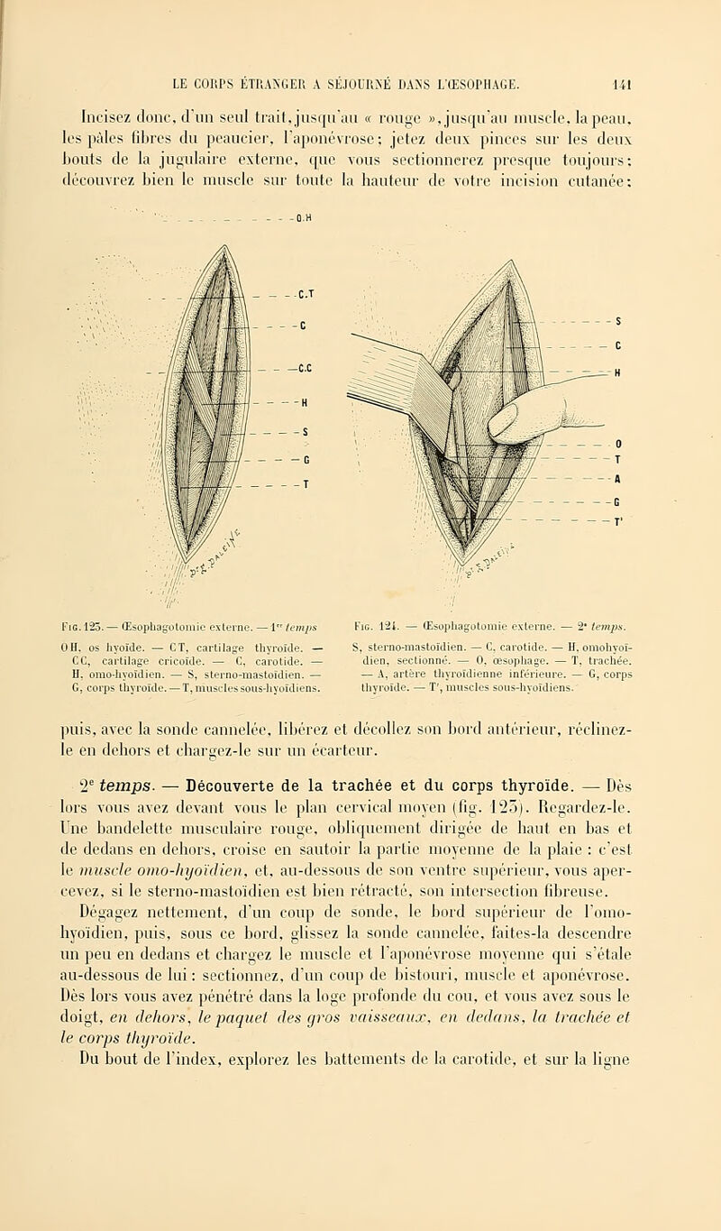Incisez donc, d'un seul trait, jusqu'au « rouge », jusqu'au muscle, la peau, les pales fibres du peaucier, l'aponévrose; jetez deux pinces sur les deux bouts de la jugulaire externe, que vous sectionnerez presque toujours: découvrez bien le muscle sur toute la hauteur de votre incision cutanée: C.T c ce H S - - G T Fig.125. — Œsophagotomie externe. —1 temps Oïï, os hyoïde. — CT, cartilage thyroïde. — CC, cartilage cricoïde. — C, carotide. — H. orao-hyoïdien. — S, sterno-mastoïdien. — G, corps thyroïde. — T, muscles sous-hyoïdiens. Fie. 124. — Œsophagotomie externe. — 2' temps. S, sterno-mastoïdien. — C. carotide. — H, omohyoï- dien. sectionné. — 0, œsophage. — T, trachée. — A, artère thyroïdienne intérieure. — G, corps thyroïde. — T', muscles sous-hyoïdiens. puis, avec la sonde cannelée, libérez et décollez son bord antérieur, réclinez- le en dehors et chargez-le sur un écarteur. '2e temps. — Découverte de la trachée et du corps thyroïde. — Dès lors vous avez devant vous le plan cervical moyen (fîg. 1*25). Regardez-le. Une bandelette musculaire rouge, obliquement dirigée de haut en bas et de dedans en dehors, croise en sautoir la partie moyenne de la plaie : c'est le muscle omo-hyoïdien, et, au-dessous de son ventre supérieur, vous aper- cevez, si le sterno-mastoïdien est bien rétracté, son intersection fibreuse. Dégagez nettement, d'un coup de sonde, le bord supérieur de l'omo- hyoïdien, puis, sous ce bord, glissez la sonde cannelée, faites-la descendre un peu en dedans et chargez le muscle et l'aponévrose moyenne qui s'étale au-dessous de lui: sectionnez, d'un coup de bistouri, muscle et aponévrose. Dès lors vous avez pénétré dans la loge profonde du cou, et vous avez sous le doigt, en dehors, le paquet des gros vaisseaux, en dedans. la trachée et le corps thyroïde. Du bout de l'index, explorez les battements de la carotide, et sur la ligne