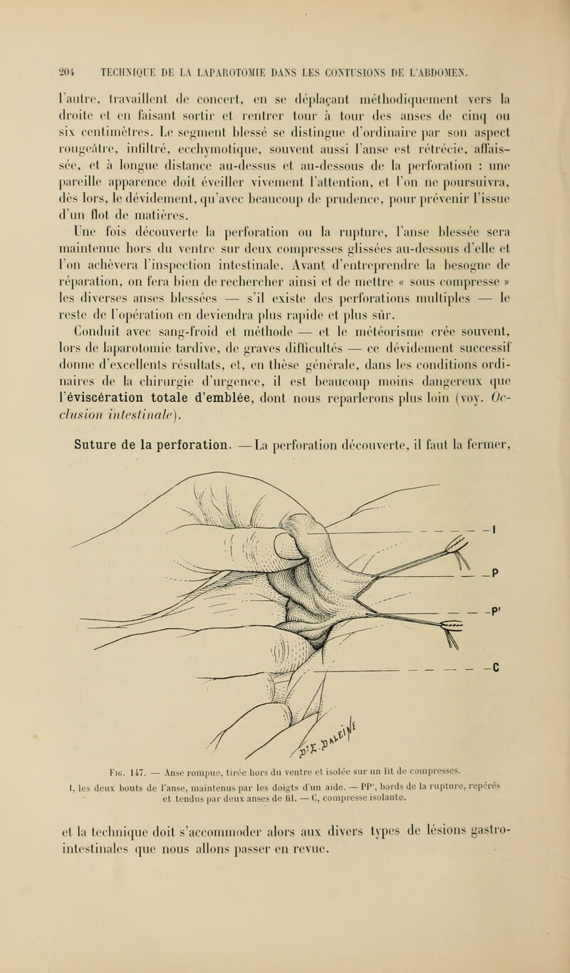 L'autre, travaillent de concert, en se déplaçant méthodiquement vers la droite et en faisant sortir et rentrer tour à tour des anses de cinq ou six centimètres. Le segment blessé se distingue d'ordinaire par son aspect rougeâtre, infiltré, ecchymotique, souvent aussi l'anse est rétrécie, affais- sée, et à longue distance au-dessus et au-dessous de la perforation : une pareille apparence doit éveiller vivement l'attention, et l'on ne poursuivra, dès lors, le dévidement, qu'avec beaucoup de prudence, pour prévenir l'issue d'un flot de matières. Une fois découverte la perforation ou la rupture, l'anse blessée sera maintenue hors du ventre sur deux compresses glissées au-dessous d'elle et l'on achèvera l'inspection intestinale. Avant d'entreprendre la besogne de réparation, on fera bien de rechercher ainsi et de mettre « sous compresse » les diverses anses blessées — s'il existe des perforations multiples — le reste de l'opération en deviendra plus rapide et plus sur. Conduit avec sang-froid et méthode — et le météorisme crée souvent, lors de laparotomie tardive, de graves difficultés — ce dévidement successif donne d'excellents résultats, et, en thèse générale, dans les conditions ordi- naires de la chirurgie d'urgence, il est beaucoup moins dangereux que l'éviscération totale d'emblée, dont nous reparlerons plus loin (voy. Oc- clusion intestinale). Suture de la perforation. —La perforation découverte, il faut la fermer. Fig. 117. — Anse mm] tirée hors du rentre et isolée *»i' un lit de c pr les deux bouts Je l'anse, maintenus par les doigts d'un aide. — l'I. bords de la rupture, rep irés et tendus par deux anses de (il. — C, compresse isolante. et la technique doit s'accommoder alors aux divers types de lésions gastro- intestinales que nous allons passer en revue.