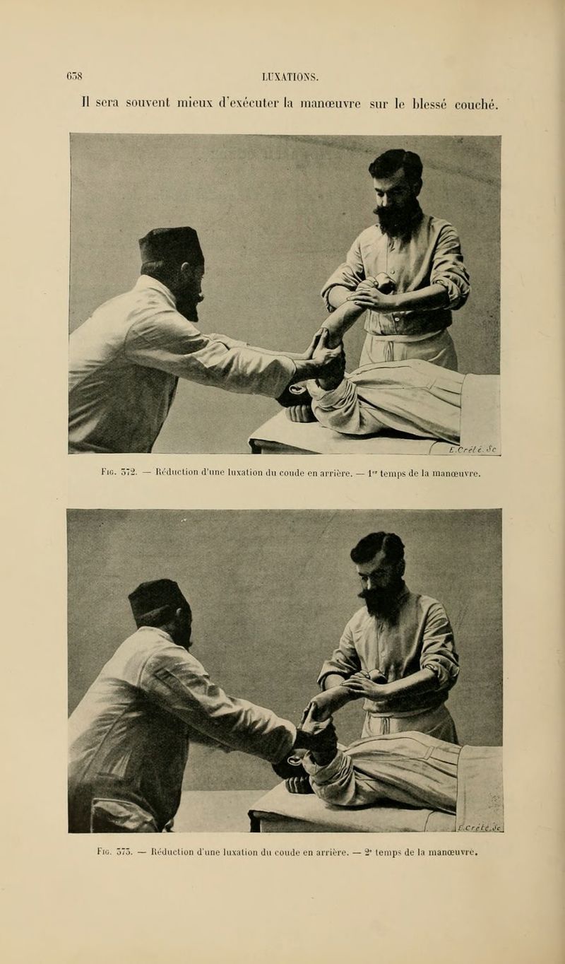 (1 sera souvent mieux d'exécuter la manœuvre sur le blessé couché. E Crili.Sc Km. Tûi. — Réduction d'une luxation du coude en arrière. — 1 temps de la manœuvre. ■'.Crjte.Jc 1 Fia. ô73. — Réduction d'une luxation du coude en arriére. — i' tenip< de la manœuvre.