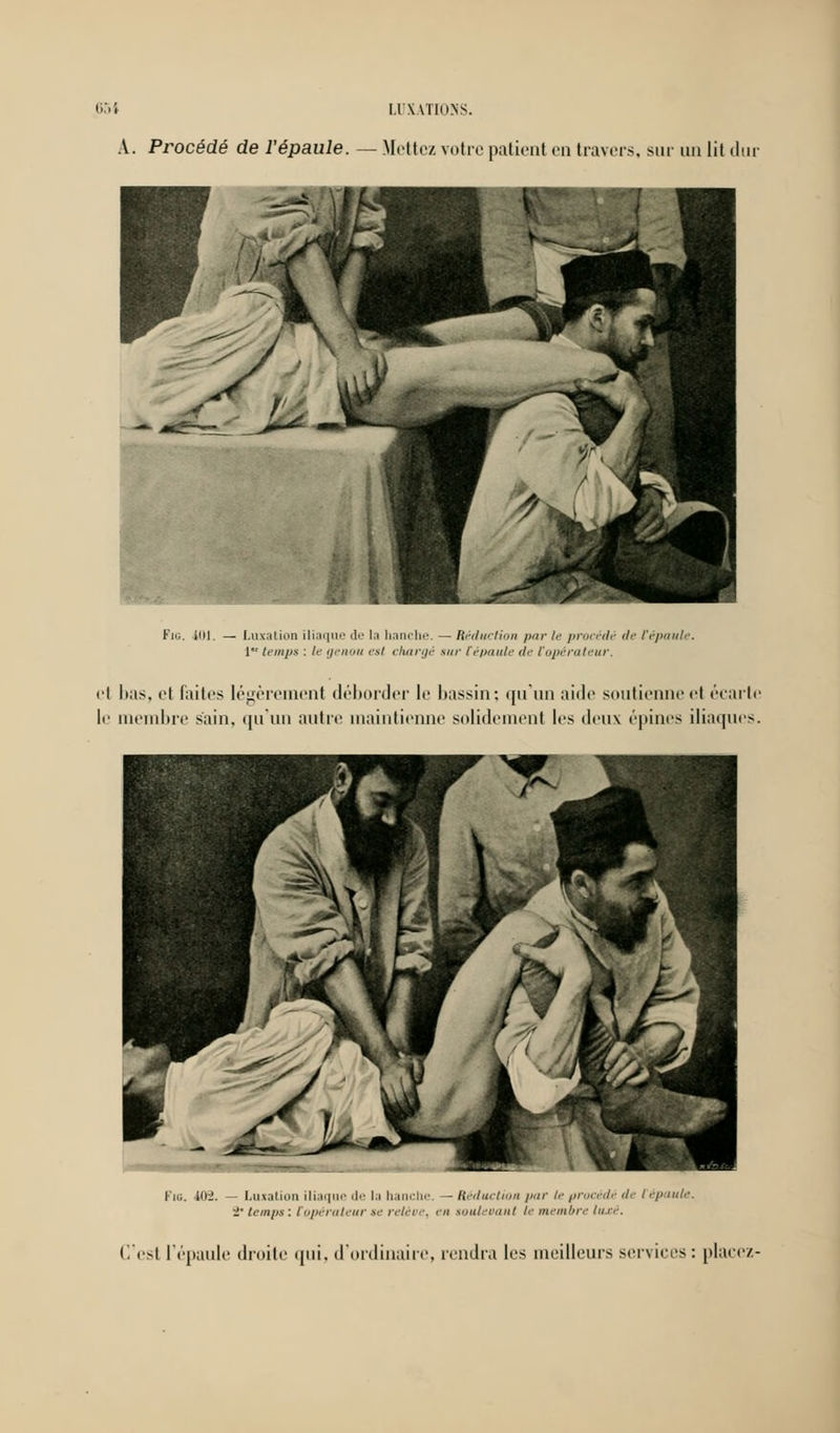 A. Procédé de l'épaule. — Mettez votre patient en travers, sur un lit dur Pig. iiU. — Luxation iliaque de la hanche. — Réduction par le procédé de l'épaule. [ temps : le genou est chargé sur {épaule de {opérateur. et lias, et laites légèrement déborder le bassin; qu'un aide soutienne et écarte le membre sain, qu'un autre maintienne solidement les deux épines iliaques. Fig. 409. — Luxation iliaque de la hanche. — Réduction par le procédé <l, i ép mie. •2' temps : {opérateur se reléee, eu soulevant le membre luxé. C'est l'épaule droite qui, d'ordinaire, rendra les meilleurs services: placez-