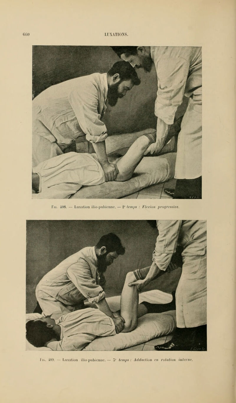 Fia, 108. — Luxation ilio-pubienne. — 2 temps : Flexion progressive Fig. iu',1 - Luxation ilio-pubienne. — ô tempsi Adduction en rotation interne