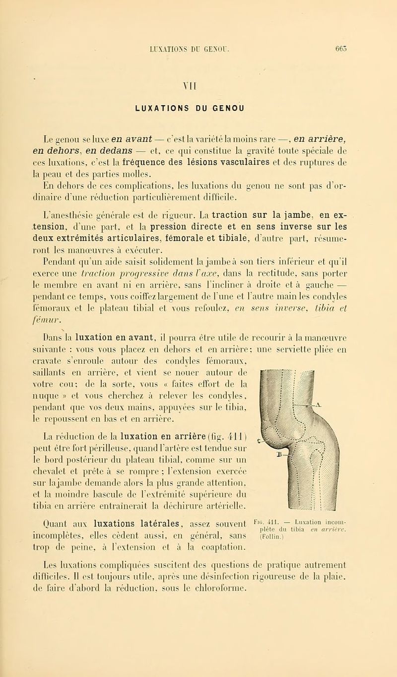 Vil LUXATIONS DU GENOU Le genou se luxe en avant — c'est la variété la moins rare —. en arrière, en dehors, en dedans — et, ee qui constitue la gravité toute spéciale de ces luxations, c'est la fréquence des lésions vasculaires et des ruptures de la peau et des parties molles. En dehors de ces complications, les luxations du genou ne sont pas d'or- dinaire d'une réduction particulièrement difficile. Lanesthésie générale est de rigueur. La traction sur la jambe, en ex- tension, d'une part, et la pression directe et en sens inverse sur les deux extrémités articulaires, fémorale et tibiale. d'autre part, résume- ront les manœuvres à exécuter. Pendant qu'un aide saisit solidement la jambe à son tiers inférieur et qu'il exerce une traction jjrogressive clans Vaxe, dans la rectitude, sans porter le membre en avant ni en arrière, sans l'incliner à droite et à gauche — pendant ce temps, vous coiffez largement de l'une et l'autre main les condyles fémoraux et le plateau tiliial et vous refoulez, en sens inverse, tibia et fémur. Dans la luxation en avant, il pourra être utile de recourir à la manœuvre suivante : vous vous placez en dehors et en arrière: une serviette pliée en cravate s'enroule autour des condyles fémoraux, saillants en arrière, et vient se nouer autour de votre cou; de la sorte, vous « faites effort de la nuque » et vous cherchez à relever les condyles. pendant que vos deux mains, appuyées sur le tibia, le repoussent en bas et en arrière. La réduction de la luxation en arrière (fig. i 1 I i peut être fort périlleuse, quand l'artère est tendue sur le bord postérieur du plateau tibial, comme sur un chevalet et prête à se rompre: l'extension exercée sur la jambe demande alors la plus grande attention, et la moindre bascule de l'extrémité supérieure du tibia en arrière entraînerait la déchirure artérielle. Quant aux luxations latérales, assez souvent incomplètes, elles cèdent aussi, en général, sans trop de peine, à l'extension et à la coaptation. Les luxations compliquées suscitent des questions de pratique autrement difficiles. Il est toujours utile, après une désinfection rigoureuse de la plaie, de faire d'abord la réduction, sous le chloroforme. Fig. 411. — Luxation incom- plète du tibia en arriére. (Follin.)