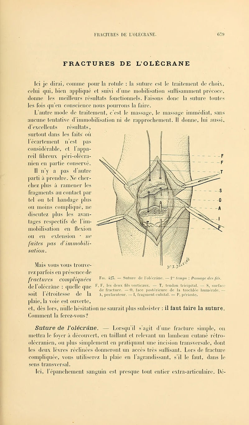 FRACTURES DE L'OLÉCRANE Ici je dirai, comme pour la rotule : la suture est le traitement de choix, celui qui, bien appliqué et suivi dune mobilisation suffisamment précoce, donne les meilleurs résultats fonctionnels. Faisons donc la suture toutes les fois qu'en conscience nous pourrons la faire. L'autre mode de traitement, c'est le massage, le massage immédiat, sans aucune tentative d'immobilisation ni de rapprochement. Il donne, lui aussi, d'excellents résultats, surtout dans les faits où l'écartement n'est pas considérable, et l'appa- reil fibreux péri-olécra- nien en partie conservé. II n'y a pas d'autre parti à prendre. Ne cher- chez plus à ramener les fragments au contact par tel ou tel bandage plus ou moins compliqué, ne discutez plus les avan- tages respectifs de l'im- mobilisation en flexion ou en extension • ne faites pas d'immobili- sation. Mais vous vous trouve- rez parfois en présence de fractures compliquées de l'oléd'âne : quelle que soit l'étroitesse de la plaie, la voie est ouverte, et, dès lors, nulle hésitation ne saurait plus subsister : il faut faire la suture. Comment la ferez-vous? Suture de ïolécrâne. — Lorsqu'il s'agit d'une fracture simple, on mettra le foyer à découvert, en taillant et relevant un lambeau cutané rétro- olécranien, ou plus simplement en pratiquant une incision transversale, dont les deux lèvres réclinées donneront un accès très suffisant. Lors de fracture compliquée, vous utiliserez la plaie en l'agrandissant, s'il le faut, dans le sens transversal. Ici, l'épanchement sanguin est presque tout entier extra-articulaire. Dé- Fia. 425. — Suture de l'olécrâne. — 1er temps : Passage des fils. F, F, les deux fils verticaux. — T. tendon tricipital. — S, surface de fracture. — 0, face postérieure de la trochlée numérale. — A, perforateur. — I, fragment cubital. — P, périoste.
