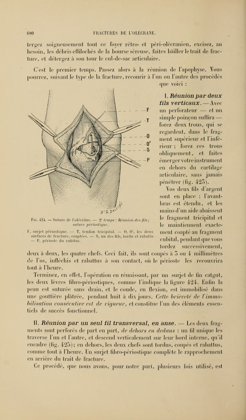 tergez soigneusement toui ce foyer rétro- el péri-olécranien, excisez, au besoin, les débris effilochés de la bourse séreuse, faites bâiller le trait de Irac- lure, et détergez à son tour le cul-de-sac articulaire. (l'est le premier temps. Passez alors â la réunion de l'apophyse. Vous pourrez, suivant le type de la fracture, recourir à l'un ou l'autre des procédés que voici : I. Réunion par deux fils verticaux. — Avec un perforateur — et un simple poinçon suffira — forez deux trous, qui se regardent, dans le frag- ment supérieur et l'infé- rieur : forez ces trous obliquement, et faites émergervotre instrument en dehors du cartilage articulaire, sans jamais pénétrer (fig. i25). Vos deux (ils d'argent sont en place : L'avant- bras est étendu, et les mains d'un aide abaissent le fragment tricipital et le maintiennent exacte- Vf-^ Fie. iïi. — Suture de l'olécrâne. — -2 temps : Kéunion des fils; suture pèriostiqtte. Y. surjet périostique. — T. tendon tricipital. — 0, 0', les deux nient coapté au fragment surfaces de fracture, coaptées. — s. un des fils, tordu el rabattu . .. , , - p, périoste du cubitus. cubital, pendant que vous tordez successivement, deux â deux, les quatre chefs. Ceci fait, ils son! coupés â . ou i millimètres de L'os, infléchis et rabattus â son contact, où le périoste les recouvrira tout à l'heure. Terminez, en effet, l'opération en réunissant, par un surjet de fin catgut, les deux lèvres fibro-périostiques, connue l'indique l;i figure i'ii. Enfin la peau est suturée sans drain, et le coude, en flexion, est i obilisé dans une gouttière plâtrée, pendant huit à dix jours. Cette brièveté de Vimmo- bilisation consécutive <■*! de rigueur, et constitue l'un des éléments essen- tiels de succès fonctionnel. II. Réunion par un seul fil transversal, en anse. — Les deux frag- ments sont perforés de part en part, de dehors en dedans : un (il unique les traverse l'un et l'autre, el descend verticalement sur leur bord interne, qu'il encadre (fig. 425); en dehors, les deux chefs sont lordus. coupés el rabattus, comme tout â l'heure. In surjet Qbro-périostique complète Le rapprochement en arrière du trait de fracture. Ce procédé, que mais avons, pour notre pari, plusieurs lois utilisé, est