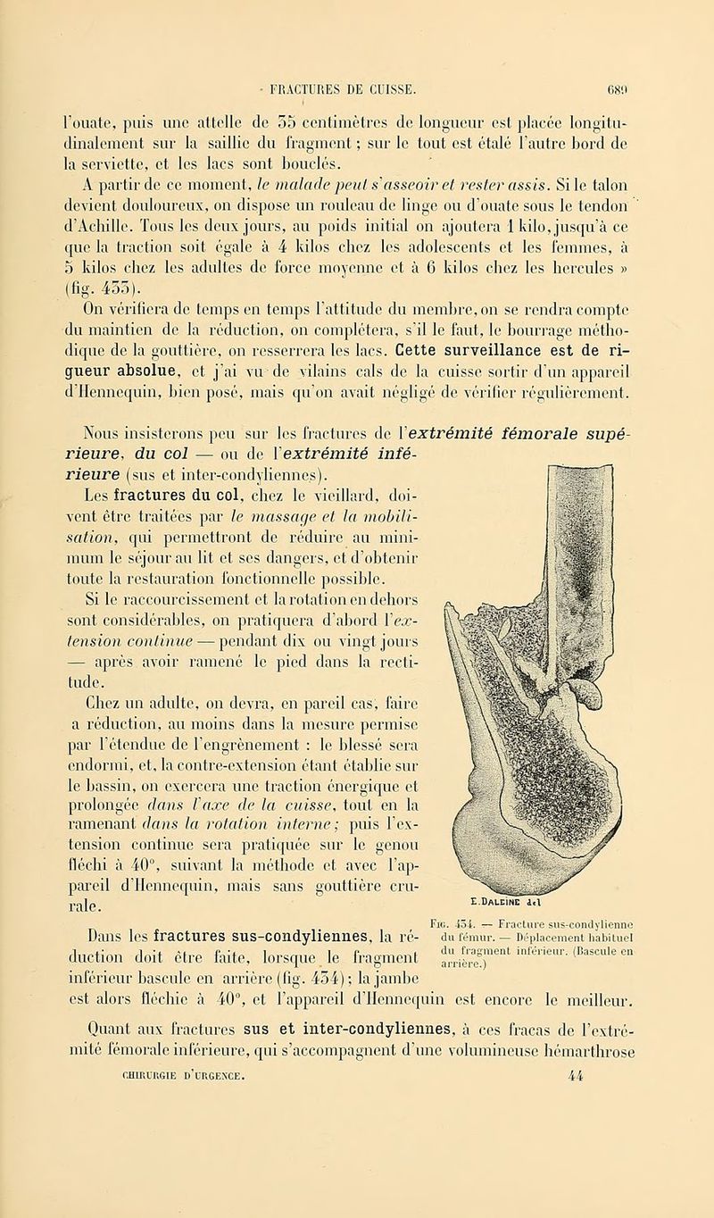 l'ouate, puis une attelle de 55 centimètres de longueur est placée longitu- dinalement sur la saillie du fragment ; sur le tout est étalé l'autre bord de la serviette, et les lacs sont bouclés. A partir de ce moment, le malade peut s'asseoir et rester assis. Si le talon devient douloureux, on dispose un rouleau de linge ou d'ouate sous le tendon d'Achille. Tous les deux jours, au poids initial on ajoutera 1 kilo, jusqu'à ce que la traction soit égale à 4 kilos chez les adolescents et les femmes, à 5 kilos chez les adultes de force moyenne et à 6 kilos chez les hercules » (fig. 455). On vérifiera de temps en temps l'attitude du membre, on se rendra compte du maintien de la réduction, on complétera, s'il le faut, le bourrage métho- dique de la gouttière, on resserrera les lacs. Cette surveillance est de ri- gueur absolue, et j'ai vu de vilains cals de la cuisse sortir d'un appareil d llcnncquin, bien posé, mais qu'on avait négligé de vérifier régulièrement. Nous insisterons peu sur les fractures de l'extrémité fémorale supé- rieure, du col — ou de l'extrémité infé- rieure (sus et inter-condylienne.s). Les fractures du col, chez le vieillard, doi- vent être traitées par le massage et la mobili- sation, qui permettront de réduire au mini- mum le séjour au lit et ses dangers, et d'obtenir toute la restauration fonctionnelle possible. Si le raccourcissement et la rotation en dehors sont considérables, on pratiquera d'abord l'ex- tension continue — pendant dix ou vingt jours — après avoir ramené le pied dans la recti- tude. Chez un adulte, on devra, en pareil cas, faire a réduction, au moins dans la mesure permise par l'étendue de l'cngrènement : le blessé sera endormi, et, la contre-extension étant établie sur le bassin, on exercera une traction énergique et prolongée dans l'axe de la cuisse, tout en la ramenant dans la rotation interne; puis l'ex- tension continue sera pratiquée sur le genou fléchi à 40°, suivant la méthode et avec l'ap- pareil d'Hennequin, mais sans gouttière cru- rale. E.DALE1NE i.l Fig. -loi. ^- Fracture sus-condylienne du fémur. — Déplacement habituel du fragment inférieur. (Bascule en arrière.) Dans les fractures sus-condyliennes, la duction doit être faite, lorsque le fragment inférieur bascule en arrière (tig. 454); la jambe est alors fléchie à 40°, et l'appareil d'Hennequin est encore le meilleur. Quant aux fractures sus et inter-condyliennes, à ces fracas de l'extré- mité fémorale inférieure, qui s'accompagnent d'une volumineuse hémarthrose CHIRURGIE D'URGENCE. U
