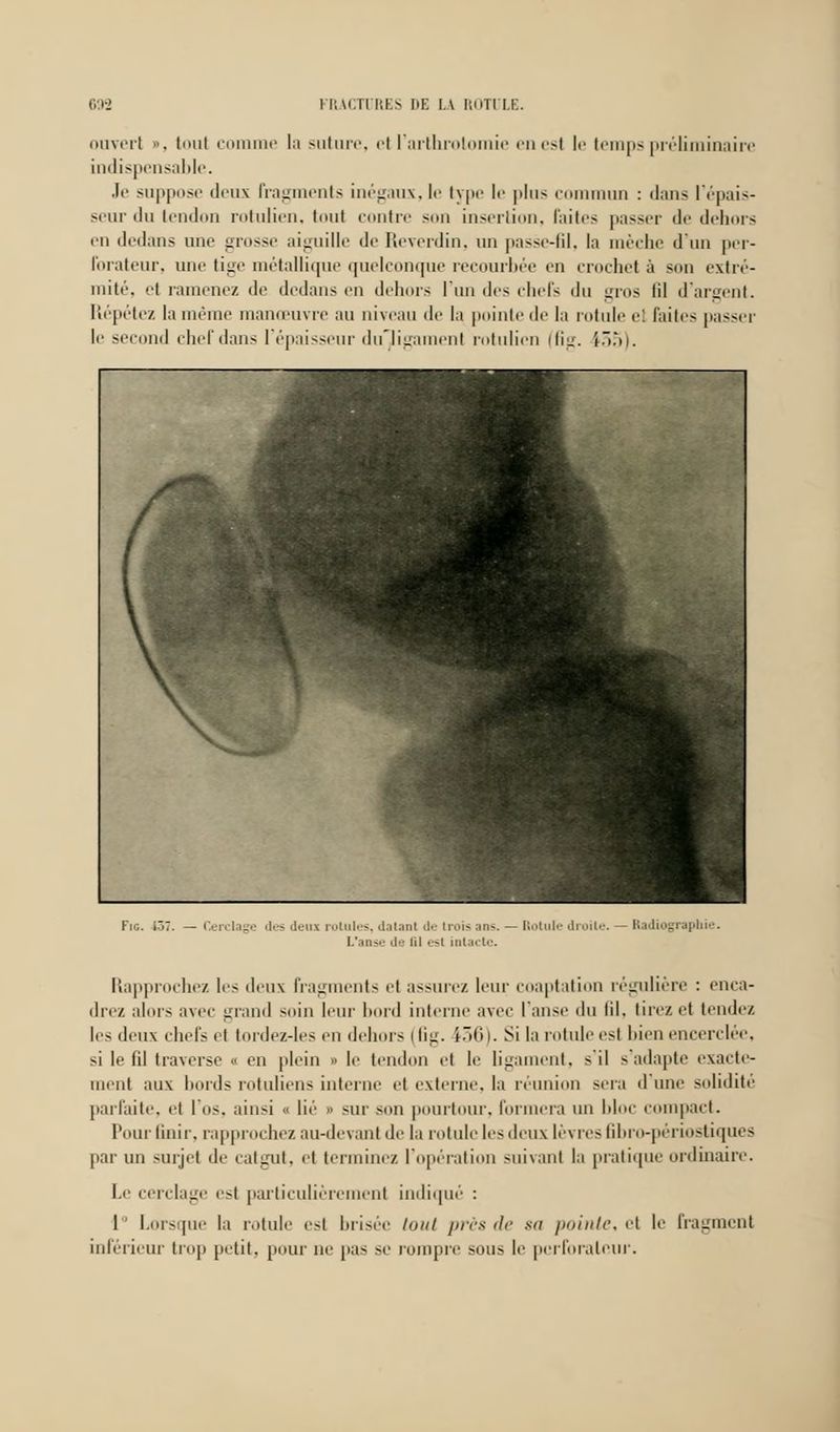 ouvert ». tout comme la suture, cl l'arthrolomie en est le temps préliminaire indispensable. Je suppose deux fragments inégaux, le type le j»l11- commun : dans l'épais- seur iln tendon rotulien, toul contre son insertion, faites passer de dehors en dedans une grosse aiguille de Reverdin, un passe-fil, la mèche d'un per- forateur, une tige métallique quelconque recourbée en crochet à son extré- mité, t ramenez de dedans en dehors l'un des chefs du gros lil d'argent. Répétez la même manœuvre au niveau de la pointe de la rotule el faites passer le second chef dans l'épaisseur duligamenl rotulien (fig. 1351. Fig. iôT i deui rotules, datant di L'an*'.- de lil e trois :m-. — Rotuli •t intacte. droite Radiographie. Rapprochez les deux fragments el assurez leur coaptation régulière : enca- drez alors avec grand suin leur bord interne avec l'anse du lil. tirez et tende/. les deux chefs et tordez-les en dehors (fig. i36). Si la rotule esl bien encerclée, si le fil traverse « en plein » le tendon et le ligament, s'il s'adapte exacte- ment aux bords rotuliens interne et externe, la réunion sera d'une solidité parfaite, et l'os, ainsi t lié • sur son pourtour, formera un bloc compact. Pour finir, rapprochez au-devant de la rotule les deux lèvres fibro-périostiques parmi surjet de catgut, et terminez l'opération suivant la pratique ordinaire. Le cerclage est particulièrement indiqué : I Lorsque la rotule est brisée tout près de sa /minie. et le fragment inférieur trop petit, pour ne i>a> se rompre sous le perforateur.