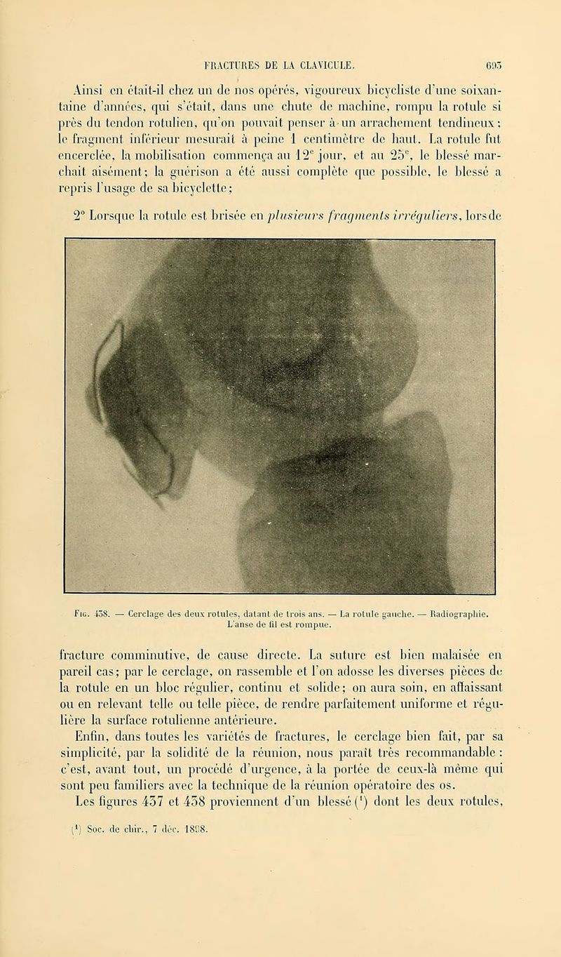 Ainsi en était-il chez un de nos opérés, vigoureux bicycliste d'une soixan- taine d'années, qui s'était, dans une chute de machine, rompu la rotule si près du tendon rotulien, qu'on pouvait penser à un arrachement tendineux; le fragment intérieur mesurait à peine 1 centimètre de haut. La rotule fut encerclée, la mobilisation commença au 12e jour, et au 25e, le blessé mar- chait aisément; la guérison a été aussi complète que possible, le blessé a repris l'usage de sa bicyclette; 2° Lorsque la rotule est brisée en plusieurs fragments irréguliers, lors de Fig. i58. — Cerclage des deux rotules, datant de trois ans. — La rotule gauche. L'anse de til est rompue. Radiographie. fracture comminutive, de cause directe. La suture est bien malaisée en pareil cas; par le cerclage, on rassemble et l'on adosse les diverses pièces de la rotule en un bloc régulier, continu et solide ; on aura soin, en affaissant ou en relevant telle ou telle pièce, de rendre parfaitement uniforme et régu- lière la surface rotulienne antérieure. Enfin, dans toutes les variétés de fractures, le cerclage bien fait, par sa simplicité, par la solidité de la réunion, nous parait très recommandable : c'est, avant tout, un procédé d'urgence, à la portée de ceux-là même qui sont peu familiers avec la technique de la réunion opératoire des os. Les figures 457 et 458 proviennent d'un blessé (') dont les deux rotules,