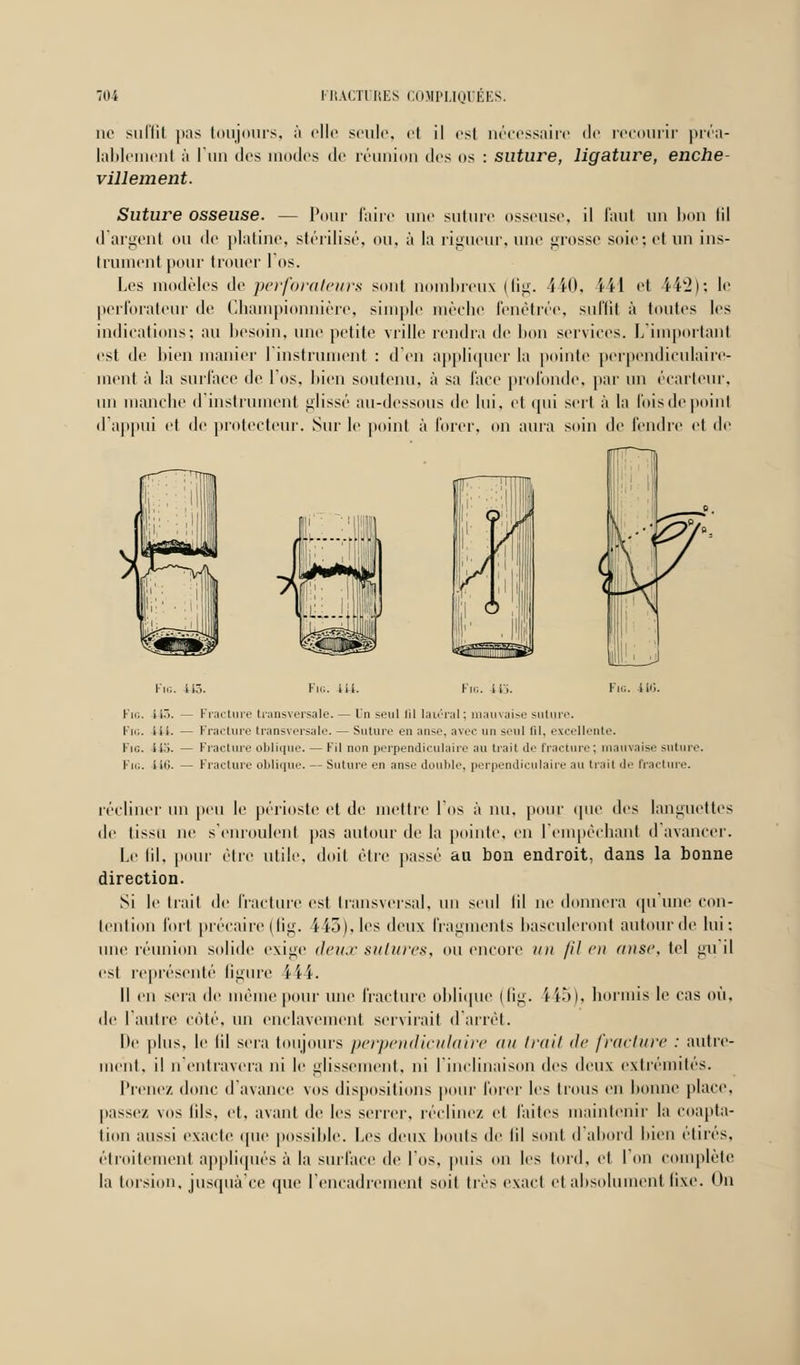 ne suffit pas toujours, à elle lablemeni à l'un des modes de villement. seule, il il est nécessaire de recourir préa- réunion des us : suture, ligature, enche- Suture osseuse. — Pour faire une suture osseuse, il faut un bon lil d'argent ou de platine, stérilisé, ou, à la rigueur, une grosse soie; et un ins- o I Do trumentpour trouer l'os. Les modèles de perforateur* sont nombreux (lig. 440, 441 et 442); le perforateur de Championnière, simple mèche Pénétrée, suffit à toutes les indications; au besoin, une petite vrille rendra de bon services. L'important est de bien manier l'instrument : d'en appliquer la pointe perpendiculaire- ment à la surface de l'os, bien soutenu, à sa face profonde, par un écarteur, un manche d'instrument glissé au-dessous de lui, et qui sert à la l'ois de point d'appui et de protecteur. Sur le point à forer, on aura soin de fendre et de Fig. 145. Fig. -H-i. Fi... Il'i. Fig. 416. Fig. ii~>. — Fracture transversale. — Un seul (il latéral; mauvaise suture. Fig. iil. — Fracture transversale. — Suture en ;ui>.'. avec un s>-nl lil. excellente. Fig. 445. — Fracture oblique. — Fil non perpendiculaire au trait de fracture; mauvaise suture. Fig. 116. — Fracture oblique. — Suture en anse douille, perpendiculaire au trait de fracture. récliner un peu le périoste et de mettre l'os à nu, pour que des languettes de tissu ne s'enroulent pas autour de la pointe, en l'empêchant d'avancer. Le lil, pour être utile, doit être passé au bon endroit, dans la bonne direction. Si le trait de fracture est transversal, un seul lil ni' donnera qu'une con- tention fort précaire (fig. 443), les deux fragments basculeront autour de lui: une réunion solide exige deux sutures, ou encore un /il eu anse, tel gu'il est représenté ligure 444. Il en sera de même pour une fracture oblique (fig. Ï45), hormis le cas où, de l'autre côté, un enclavement servirait d'arrêt. De plus, le lil sera toujours perpendiculaire au trait de fracture : autre- ment, il n'entravera ni le glissement, ni l'inclinaison des deux extrémités. Prenez donc d'avance vos dispositions pour forer les trous en lionne place, passe/, vos lils, et, avant de les serrer, réclinez et laites maintenir la coapta- lion aussi exacte que possible. Les deux bouts de lil sont d'abord bien étirés, étroitement appliqués à la surface de l'os, puis nu les tord, et l'on complète la torsion, jusquà'ce que l'encadrement soit 1res exact et absolument fixe. I In