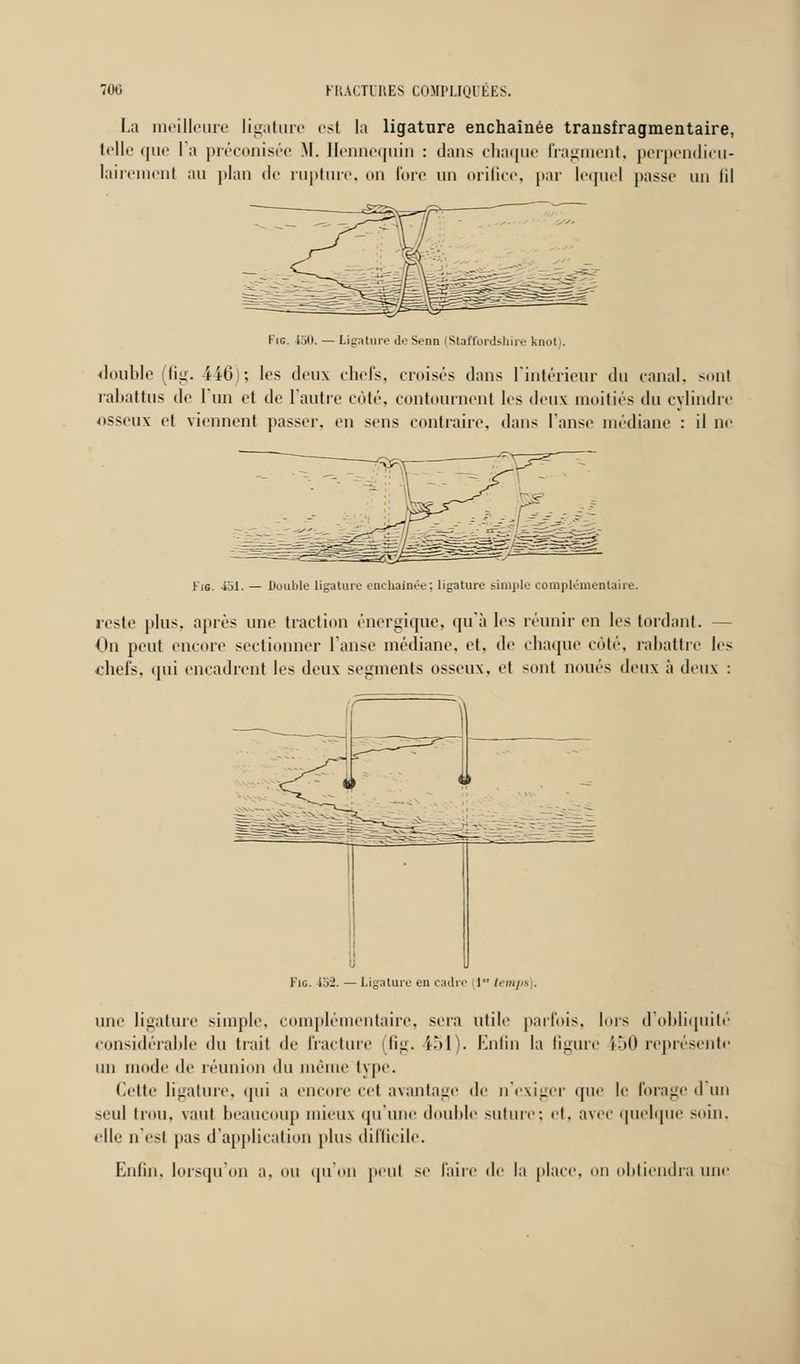 La meilleure ligature est la ligature enchaînée transfragmentaire, telle que l'a préconisée M. Hennequin : dans chaque Fragment, perpendicu- lairement au plan de rupture, on fore un orifice, par lequel passe un lil Fig. i30. — Ligature deSenn (Staffordshire knoti. double (fig. 446); les deux chefs, croisés dans l'intérieur du canal, sont rabattus de l'un et de l'autre côté, contournent les deux moitiés du cylindre osseux et viennent passer, en sens contraire, dans l'anse médiane : il ne Fig. 451. — Double ligature enchaînée; ligature simple complémentaire. reste plus, après une traction énergique, qu'à les réunir en les tordant. — On peut encore sectionner l'anse médiane, et, de chaque côté, rabattre les chefs, qui encadrent les deux segments osseux, et -ont noués deux à deux : Fie. 152. — Ligature en cadri' 11 t'-'iit/^ . une ligature simple, complémentaire, sera utile parfois, lors d'obliquité considérable du trait de fracture (fig. 151). Enfin la ligure i.M) représente un mode de réunion du même type. dette ligature, qui a encore cet avantage de n'exiger que le l'orage d'un seul trou, vaut beaucoup mieux qu'une double suture: et, avec quelque soin, elle n'est pas d'application plus difficile. Enfin, lorsqu'on a. ou qu'on peut se l'aire de la place, ou obtiendra une