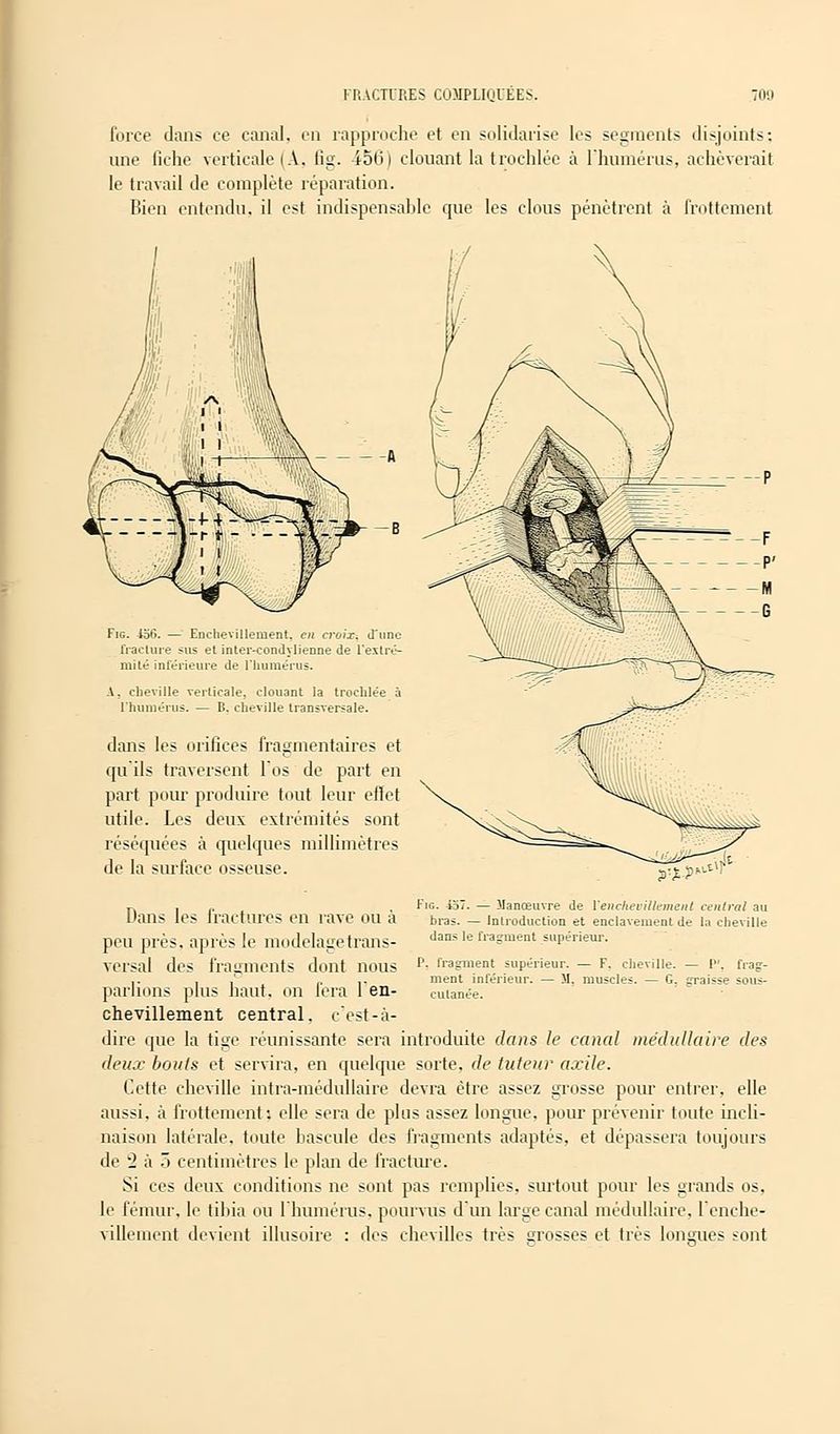 force dans ce canal, en rapproche et en solidarise les segments disjoints: une fiche verticale (A. fig. 456) clouant la trochlée à l'humérus, achèverait le travail de complète réparation. Bien entendu, il est indispensable que les clous pénètrent à frottement Fig. 45tï. — Enchevilleuient. en croix, d'une fracture sus et inter-condylienne de l'extré- mité intérieure de l'humérus. A, cheville verticale, clouant la trochlée à l'humérus. — K. cheville transversale. dans les orifices fragmentaires et qu'ils traversent l'os de part en part pour produire tout leur effet utile. Les deux extrémités sont réséquées à quelques millimètres de la surface osseuse. V%P>^ Fig. lo't. — llanœuvre de Y enchevillement central au bras. — Introduction et enclavement de la cheville dans le fragment supérieur. P. fragment supérieur. — F. cheville. — P'. frag- ment inférieur. — M. muscles. — G. graisse sous- cutanée. Dans les fractures en rave ou à peu près, après le modelage trans- versal des fragments dont nous parlions plus haut, on fera l'en- chevillement central, c'est-à- dire que la tige réunissante sera introduite dans le canal médullaire des deux bouts et servira, en quelque sorte, de tuteur axile. Cette cheville intra-médullaire devra être assez grosse pour entrer, elle aussi, à frottement', elle sera de plus assez longue, pour prévenir toute incli- naison latérale, toute bascule des fragments adaptés, et dépassera toujours de ■} à 5 centimètres le plan de fracture. Si ces deux conditions ne sont pas remplies, surtout pour les grands os, le fémur, le tibia ou l'humérus, pourvus d'un large canal médullaire, l'enche- villement devient illusoire : des chevilles très grosses et très longues sont