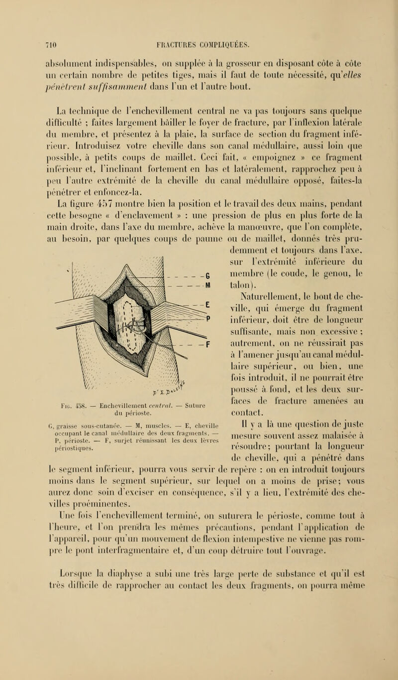 absolument indispensables, on supplée à la grosseur en disposant côte à côte un certain nombre «le petites ti^cs, mais il faut de toute nécessité, qu'eues pénètrent suffisamment dans l'un et l'autre bout. La technique de l'enchevillement central ne va pas toujours sans quelque difficulté ; laites largement bâiller le foyer de fracture, par I inflexion latérale du membre, et présentez à la plaie, la surface de section du fragment infé- rieur. Introduise/, votre cheville dans son canal médullaire, aussi loin que possible, à petits coups de maillet. Ceci fait, « empoignez » ce fragment inférieur et, l'inclinant fortement en bas et latéralement, rapprochez peu à peu l'autre extrémité de la cheville du canal médullaire opposé, faites-la pénétrer et enfoncez-la. La figure 457 montre bien la position et le travail des deux mains, pendant cette besogne « d'enclavement >> : une pression de plus en plus forte de la main droite, dans l'axe du membre, achève la manœuvre, que l'on complète, au besoin, par quelques coups de paume ou de maillet, donnés très pru- demment et toujours dans l'axe, sur l'extrémité inférieure du membre (le coude, le genou, le talon). Naturellement, le bout de che- ville, qui émerge du fragment inférieur, doit être de longueur y'ïJD 458. — Enchevîllement central. du périoste. Suture suffisante, mais non excessive ; autrement, on ne réussirait pas à ramener jusqu'au canal médul- laire supérieur, ou bien, une fois introduit, il ne pourrait être poussé à fond, et les deux sur- faces de fracture amenées au contact. Il y a là une question de juste mesure souvent assez malaisée à résoudre; pourtant la longueur de cheville. i|iii a pénétré dans li' segment inférieur, pourra vous servir de repère : on en introduit toujours moins dans le segment supérieur, sur lequel ou a moins de prise; vous aurez donc soin d'exciser en conséquence, s'il y a lieu, l'extrémité des che- villes proéminentes. I ne l'ois 1 enchevillement terminé, on suturera le périoste, connue (oui à l'heure, et Ion prendra les mêmes précautions, pendant l'application île l'appareil, pour qu mi mouvement de flexion intempestive ne vienne pas rom- pre le pool interfragmentaire et, d'un coup détruire tout l'ouvrage. i-, graisse sous-cutanée. — M, muscles. — E, cheville occultant le canal médullaire des deux fragments, — I'. périoste. — F. surjet réunissant les deux lèvres périostiques. Lorsque la diaphyse a suhi une très large perte de substance et qu'il est très difficile de rapprocher au contact les deux fragments, on pourra même