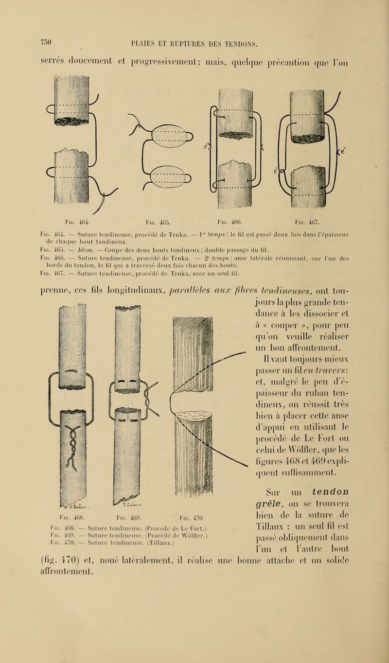 serres doucement et progressivement; mais, quelque précaution que I' FlG. 464. Fie. 46b. Fig. 466. Fin. 167. In;, itii. — Suture tendineuse, procédé de Trnka. — 1 temps : le lil est passé deux fois dans l'épaisseur de chaque bout tandineux. Fig. 163. — li/cni. — Coupe des iltux bouts tendineux ; double passage du fil. Fin. 466. — Suture tendineuse, procédé de Trnka. — 2' temps : anse latérale réunissant, sur l'un des bords du tendon, le lil qui a traversé deux fois chacun des bouts. Fin. 467. — Suture tendineuse, procédé de Trnka, avec un seul til. prenne, ces lils longitudinaux, parallèles aux fibres tendineuses, oui tou- jours la plus grande ten- dance à les dissocier el à « couper », pour peu qu'on veuille réaliser un lion affrontement. Il vaut toujours mieux passer un lil en travers: et. malgré le peu d'é- paisseur lin ruban ten- dineux, on réussit très bien à placer celle anse d'appui en utilisant le procédé de Le Fort ou Celui île Wnlller. que les figures il'.Sel i69 expli- quent suffisamment. Sur nu tendon grêle, un se trouvera bien île la suture de Tillaus : un seul lil esl passé obliquement dans l'un et l'autre bout (fig. 170) et. noué latéralement, il réalise une bonne attache et un solide affrontement. I io. 170 I m. 168. — Suture tendineuse. (Procédé de Le Fort.) Fn.. 169. — Suture tendineuse. (Procédé de WolOer.)