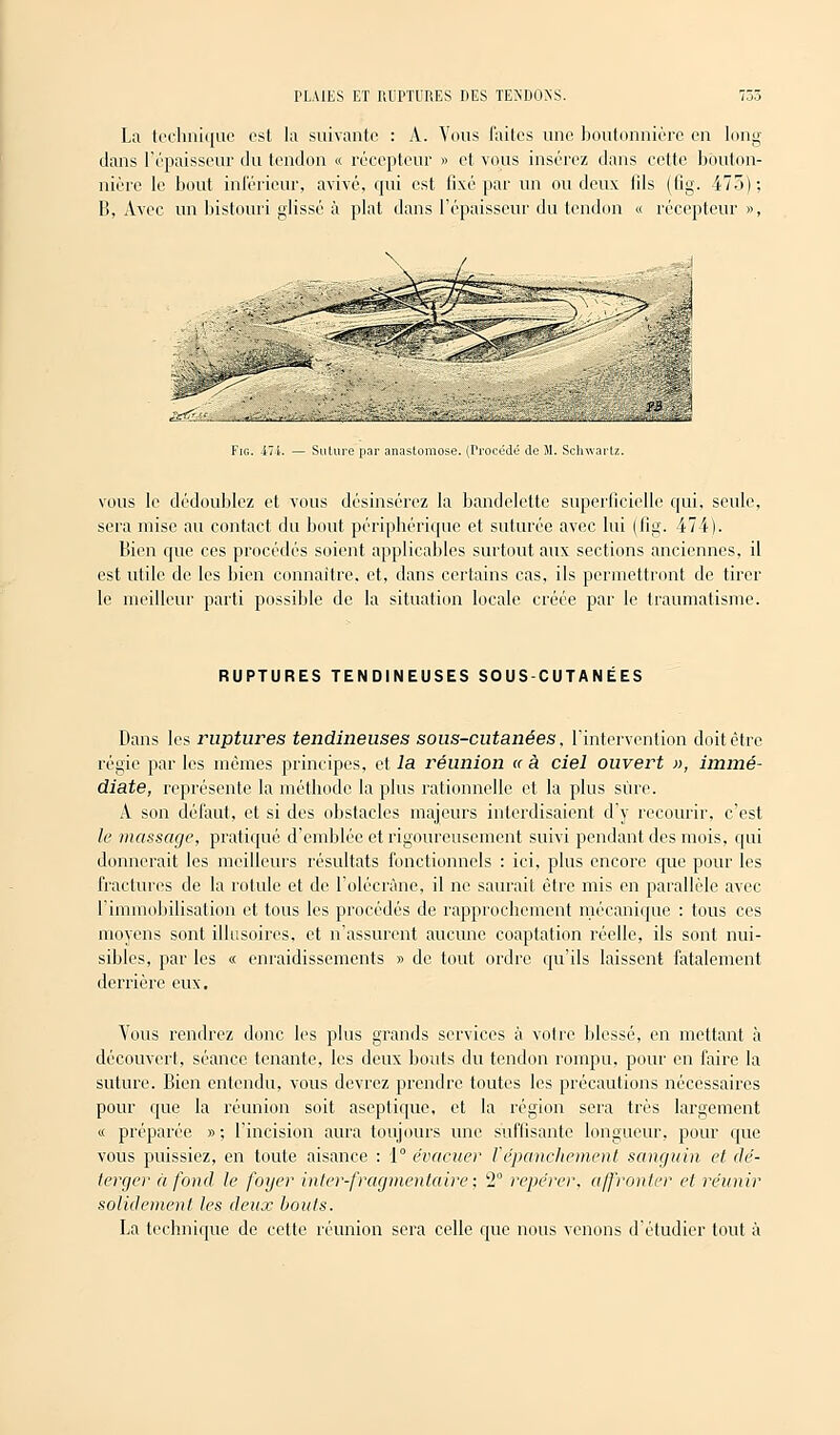 La technique est la suivante : A. Vous faites une boutonnière en long dans l'épaisseur du tendon « récepteur » et vous insérez dans cette bouton- nière le bout inférieur, avivé, qui est fixé par un ou deux fils (fig. 475); B, Avec un bistouri glissé à plat dans l'épaisseur du tendon « récepteur », ie^:'-'.. «. ., r „ ,, ^__ ,r, ... , -',',. ,,«- , „ ^>-Ja Fig. 474. — Suture par anastomose. (Procédé de M. Sclrwartz. vous le dédoublez et vous désinsérez la bandelette superficielle qui, seule, sera mise au contact du bout périphérique et suturée avec lui (fig. 474). Bien que ces procédés soient applicables surtout aux sections anciennes, il est utile de les bien connaître, et, dans certains cas, ils permettront de tirer le meilleur parti possible de la situation locale créée par le traumatisme. RUPTURES TENDINEUSES SOUS-CUTANEES Dans les ruptures tendineuses sous-cutanées, l'intervention doit être régie par les mômes principes, et la réunion « à ciel ouvert », immé- diate, représente la méthode lapins rationnelle et la plus sûre. A son défaut, et si des obstacles majeurs interdisaient d'y recourir, c'est le massage, pratiqué d'emblée et rigoureusement suivi pendant des mois, qui donnerait les meilleurs résultats fonctionnels : ici, plus encore tpie pour les fractures de la rotule et de l'olécràne, il ne saurait être mis en parallèle avec l'immobilisation et tous les procédés de rapprochement mécanique : tous ces moyens sont illusoires, et n'assurent aucune coaptation réelle, ils sont nui- sibles, par les « enraidissements » de tout ordre qu'ils laissent fatalement derrière eux. Vous rendrez donc les plus grands services à votre blessé, en mettant à découvert, séance tenante, les deux bouts du tendon rompu, pour en faire la suture. Bien entendu, vous devrez prendre toutes les précautions nécessaires pour que la réunion soit aseptique, et la région sera très largement « préparée » ; l'incision aura toujours une suffisante longueur, pour que vous puissiez, en toute aisance : 1° évacuer Vépanchement sanguin et dé- terger à fond le foyer inler-fragmentaire; 2° repérer, affronter et réunir solidement les deux bouts. La technique de cette réunion sera celle que nous venons d'étudier tout à
