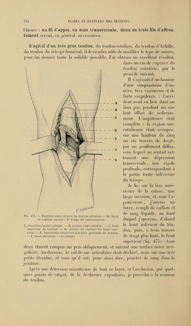 l'heure : un fil d'appui, en anse transversale, deux ou trois fils d'affron- tement seront, en général, nécessaires. S'agit-il d'un très gros tendon, du tendon rotulien, du tendon d'Achille, du tendon du triceps humerai, il deviendra utile de modifier le type de suture, pour lui donner toute la solidité possible. J'ai obtenu un excellent résultat, dans un cas de rupture du taillai! rotulien, par le procédé suivant. Il s'agissait d'un homme d'une cinquantaine d'an- nées, très vigoureux et de forte corpulence : I acci- dent avait eu lieu dans un Faux pas. pendant un vin- lent effort de redresse- ment . L'impotence était complète : la région sus- d rotulicnne était occupée, sur une hauteur de cinq OU siv. travers de doigt. par un gonflement diffus, sous leipiel on sentait net- tement une dépression transversale, une rigole profonde, correspondant à la partie toute inférieure du triceps. Je lis. sur la face anté- rieure de la cuisse, une large incision, et, sous I a- poiiévrose, j'ouvris un loyer, rempli de caillots et de sang liquide, au fond duquel j'aperçus, d'abord ?'•?■?' Fio. 175. — Rupture sous-cutanée du tendon rotulien.— Le foj de rupture ouvert : l temps de l'intervention. A, manchon aponévrotique. — B, graisse sous-cutanée. — C, bout 5 UOIlt intérieur du leli- supérieur du tendon. — D, surface de rupture du bout supé- don, puis, à trois travers rieur.— E, bandelette conservée à la l'ace profonde du tendon. ' ! — F. I t inférieur. — G, rotule, de doigl plus liant, le I ti Mit supérieur i Gg. i7T>) : tous deux étaient rompus un peu obliquement, et suivant une surface assez irré- gulière. Au-dessous, le cul-de-sac articulaire était déchiré, mais sur une très petite étendue, et sans qu'il eût, pour ainsi dire, pénétré de sang dans la jointure. Après une détersion minutieuse de tout ce lover, et l'occlusion, par quel- ques points de catgut, de la déchirure capsulaire, jeprocédaià la réunion du tendon.