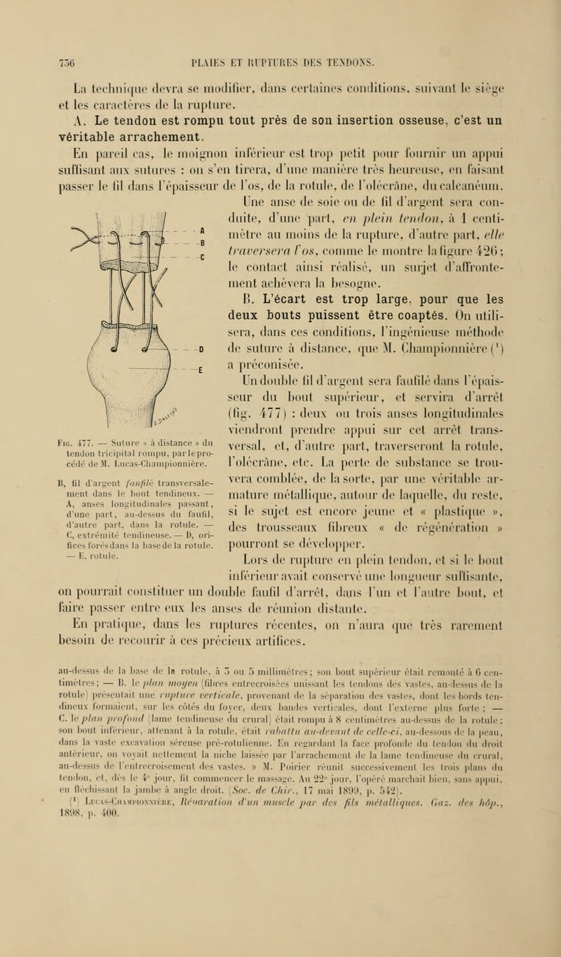 La technique devra se modifier, dans certaines conditions, suivant le siège et les caractères de la rupture. A. Le tendon est rompu tout près de son insertion osseuse, c'est un véritable arrachement. En pareil cas, le moignon inférieur est trop petit pour Fournir un appui suffisant aux sutures : on s'en tirera, d'une manière très heureuse, en faisant passer le lil dans l'épaisseur de 10s, de la rotule, de l'olécrâne, ducalcanéum. Une anse de suie ou de lil d'argenl sera con- duite, d'une part, en plein tendon, à 1 centi- mètre au moins de la rupture, d'autre part, elle traversera Vos, comme le montre la figure ik2ti: le contact ainsi réalisé, un surjet d'affronte- ment achèvera la besogne. B. L'écart est trop large, pour que les deux bouts puissent être coaptés. On utili- sera, dans ces conditions, l'ingénieuse méthode -o de suture à distance, que M. Çhampionmère(') E a préconisée. Un double Gl d'argent sera faufilé dans l'épais- seur du bout supérieur, et servira d'arrêt (fit 4 / / ) : deu \ ou t rois anses longitudinal* viendront prendre appui sur cet arrêt trans- versal, et, d'autre part, traverseront la rotule, l'olécrâne, etc. La perte de substance se trou- vera comblée, de la sorte, par une véritable ar- mature métallique, autour de laquelle, du reste, si le sujet est encore jeune et « plastique », des trousseaux fibreux « de régénération » pourront se développer. Lors de rupture en plein tendon, et si le bout inférieur avait conservé une longueur suffisante, on pourrait constituer un double faufil d'arrêt, dans l'un et l'autre bout, et l'aire passer entre eux les anses de réunion distante. En pratique, dans les ruptures récentes, on n'aura que très rarement besoin de recourir à ces précieux artifices. Fig. 177. — Suture à distance » du tendon tricipital rompu, parlepro- cédé de M. Lucas-Champîonnière. Iî, lil d'argent faufilé transversale- ment dans le bout tendineux. — A, anses longitudinales passant, d'une part, au-dessus du faufil, d'autre part, dans la rotule. — C, extrémité tendineuse. — D, ori- fices forésdans la basede la rotule. — E, rotule. au-dessus de la base de In rotule, à 3 ou ô millimètres; son Luit supérieur était remonte à 6 cen- timètres; — II. Ii- /ilmi moyen [filtres entrecroisées unissanl les tendons des vastes, au-dessus de la rotule présentait nue rupture verticale, provenant de la séparation des vastes, donl les bords len- < I i ■ i • -11 x formaient, sur les côtés du foyer, deux bandes verticales, <liii l'externe plus forte i — C. le l'Uni profond lame tendineuse < 111 crural] était rompu à S centimètres au-dessus de la rotule; son ]>iii inférieur, attenant à la rotule, était rabattu au-devant de celle-ci, au-dess de la peau, dans la vaste excavation séreuse pré-rotulienne, En regardant la face profonde du tendon du droil antérieur, on royail nettement la niche laisse.' par l'arrachement de la lame tendineuse du crural, au-dessus de l'entrecroisement des vastes. » M. Poirier réunil successivemenl les trois plan- .In tendon, et, dès le fr jour, lil commencer te massage. An 22* jour, l'opéré marchail bien, sans appui, en Déchissanl la jambe à angle droit. Soc. de Chir., 17 mai 1899, p. M'J . 1 la. \-( imiri.iwii i; , Réoaralion d'un muscle par des fils métalliques. Gaz. des Ad»., 1898, p. 100.