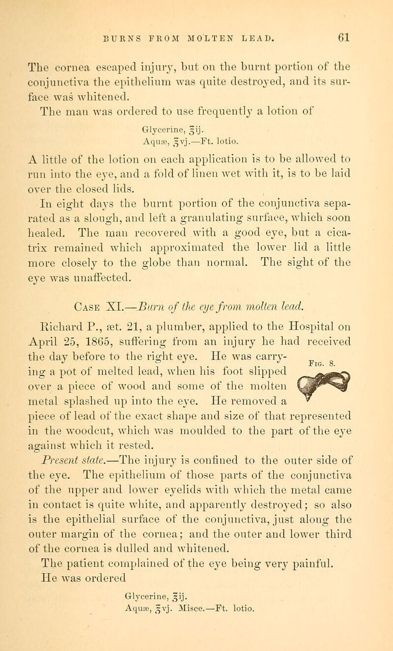 The cornea escaped injury, but on the burnt portion of the conjunctiva the epithelium was quite destroyed, and its sur- face was whitened. The man was ordered to use frequently a lotion of Glycerine, gij. Aquae, 5VJ.—Ft. lotio. A little of the lotion on each application is to be allowed to run into the eye, and a fold of linen wet with it, is to be laid over the closed lids. In eight days the burnt portion of the conjunctiva sepa- rated as a slough, and left a granulating surface, which soon healed. The man recovered with a good eye, but a cica- trix remained which approximated the lower lid a little more closely to the globe than normal. The sight of the eye was unaffected. Case XI.—Barn of the eye from molten lead. Richard P., set. 21, a plumber, applied to the Hospital on April 25, 1865, suff'eriug from an injury he had received the day before to the right eye. He was carry- ing a pot of melted lead, when his foot slipped over a piece of wood and some of the molten metal splashed up into the eye. He removed a piece of lead of the exact shape and size of that represented in the woodcut, which was moulded to the part of the eye against which it rested. Present state.—The injury is confined to the outer side of the eye. The epithelium of those parts of the conjunctiva of the upper and lower eyelids with which the metal came in contact is quite white, and apparently destroyed; so also is the epithelial surface of the conjunctiva, just along the outer margin of the cornea; and the outer and lower third of the cornea is dulled and whitened. The patient complained of the eye being very painful. He was ordered Glycerine, %\]. Aqure, ;§vj. Misce.—Ft. lotio.