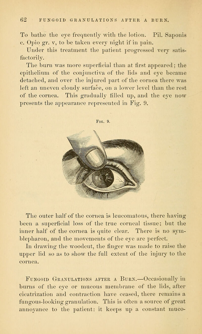 To bathe the e}-e frequently with the lotion. Pil. Saponis c. Opio gr. v, to be taken every night if in pain. Under this treatment the patient progressed very satis- factorily. The burn was more superficial than at first appeared; the epithelium of the conjunctiva of the lids and eye became detached, and over the injured part of the cornea there was left an uneven cloudy surface, on a lower level than the rest of the cornea. This gradually filled up, and the eye now presents the appearance represented in Fig. 9. Fig. 9. The outer half of the cornea is leucomatous, there having been a superficial loss of the true corneal tissue; but the inner half of the cornea is quite clear. There is no sym- blepharon, and the movements of the eye are perfect. In drawing the woodcut, the finder was made to raise the upper lid so as to show the full extent of the injury to the cornea. Fungoid Granulations after a Burn.—Occasionally in burns of the eye or mucous membrane of the lids, after cicatrization and contraction have ceased, there remains a fungous-looking granulation. This is often a source of great annoyance to the patient: it keeps up a constant muco-