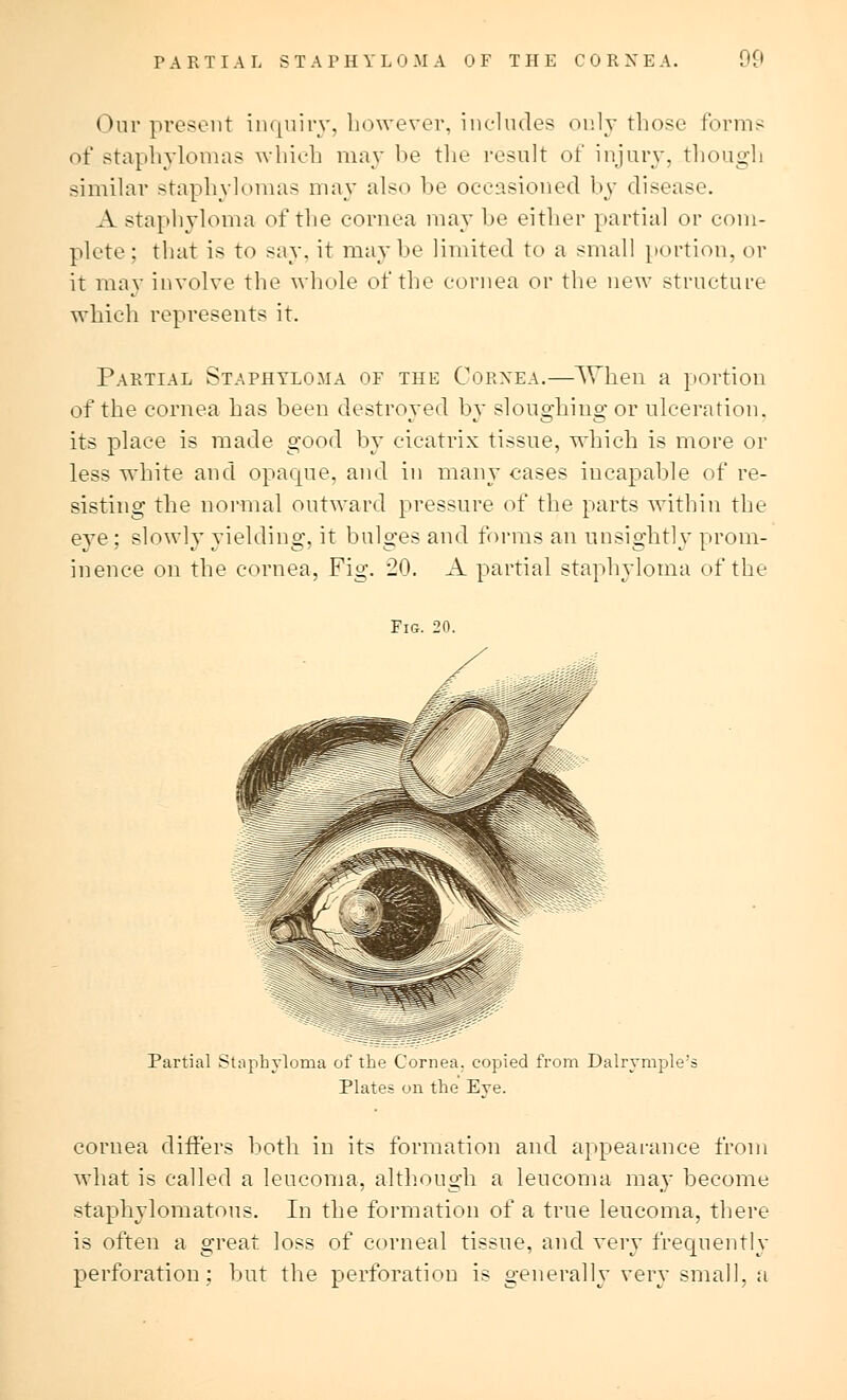 Our present inquiry, however, includes only those forms of staphylomas which may be the result of injury, though similar staphylomas may also be occasioned by disease A staphyloma of the cornea may be either partial or com- plete : that is to say. it maybe limited to a small portion, or it may involve the whole of the cornea or the new structure which represents it. Partial Staphyloma of the Cornea.—TThen a portion of the cornea has been destroyed by sloughing or ulceration, its place is made good by cicatrix tissue, which is more or less white and opaque, and in many cases incapable of re- sisting the normal outward pressure of the parts within the eye; slowly yielding, it bulges and forms an unsightly prom- inence on the cornea, Fig. 20. A partial staphyloma of the Fig. 20. Partial Staphyloma of the Cornea, copied from Dalrymple' Plates on the Eve. cornea differs both in its formation and appearance from what is called a leucoma, although a leucoma may become staphylomatous. In the formation of a true leucoma, there is often a great loss of corneal tissue, and very frequently perforation; but the perforation is generally very small, a