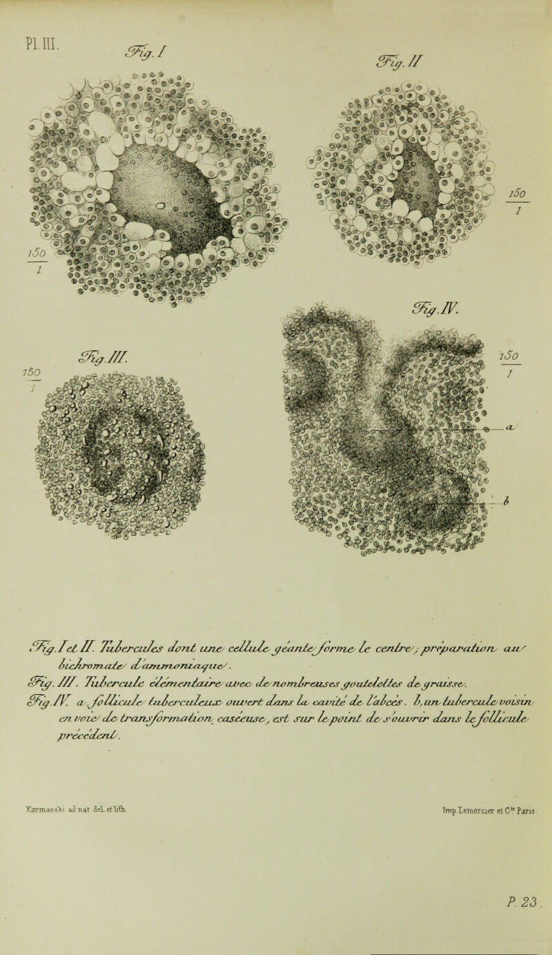 pi m. ^.// 4.1 *- S&2 /5 »r.> 5 SMÏ- / 7o>0 / • Aç.t et 11. Juveraz/es dont'une cetlute j/eemleyormele cenlrc; prepuratutn, au/ oieAromaie Jammoniaque/'. Sriff.///. 7ut>crcutc e/cmenJeus-eavecJe nombreuses t/oiUe/ettes de-graisse.. Eng.fr. a .Jolliaz/e ùeocrculeiuc oui'ert dans Le azviiéJe l'aicès. f>. un, ùt/tercalevoisin en l'oieJe trans/ormaiion caseeuse,, est sur le point Je s ouvrir Jans le/olurule.- précèdent. Ksrcnaîiftki ajttat ieLetlitK Imp lemercier et Cle Pans