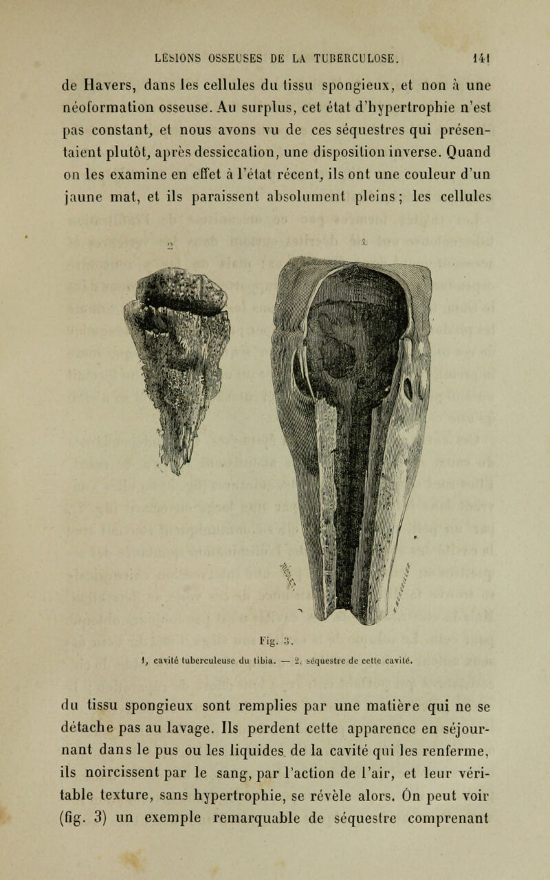 de Havers, dans les cellules du tissu spongieux, et non à une néoformation osseuse. Au surplus, cet état d'hypertrophie n'est pas constant, et nous avons vu de ces séquestres qui présen- taient plutôt, après dessiccation, une disposition inverse. Quand on les examine en effet à l'état récent, ils ont une couleur d'un jaune mat, et ils paraissent absolument pleins; les cellules Fig. :;. t, cavité tuberculeuse du tibia. — ii. séquestre de cette cavité. du tissu spongieux sont remplies par une matière qui ne se détache pas au lavage. Ils perdent cette apparence en séjour- nant dans le pus ou les liquides de la cavité qui les renferme, ils noircissent par le sang, par l'action de l'air, et leur véri- table texture, sans hypertrophie, se révèle alors. On peut voir (fig. 3) un exemple remarquable de séquestre comprenant