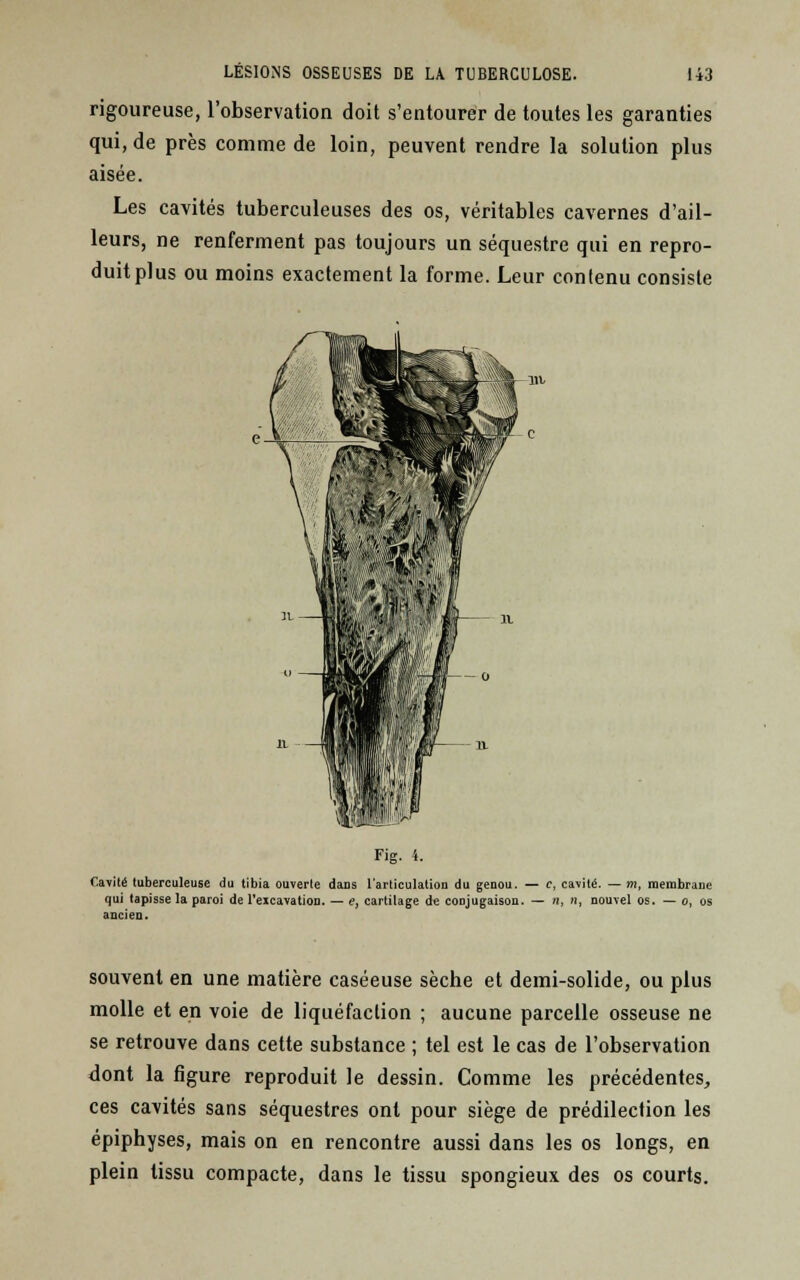 rigoureuse, l'observation doit s'entourer de toutes les garanties qui, de près comme de loin, peuvent rendre la solution plus aisée. Les cavités tuberculeuses des os, véritables cavernes d'ail- leurs, ne renferment pas toujours un séquestre qui en repro- duit plus ou moins exactement la forme. Leur contenu consiste Fig. 4. Cavité tuberculeuse du tibia ouverte daiis l'articulation du genou. — c, cavité. — m, membrane qui tapisse la paroi de l'excavation. — e, cartilage de conjugaison. — n, n, nouvel os. — o, os ancien. souvent en une matière caséeuse sèche et demi-solide, ou plus molle et en voie de liquéfaction ; aucune parcelle osseuse ne se retrouve dans cette substance ; tel est le cas de l'observation dont la figure reproduit le dessin. Comme les précédentes, ces cavités sans séquestres ont pour siège de prédilection les épiphyses, mais on en rencontre aussi dans les os longs, en plein tissu compacte, dans le tissu spongieux des os courts.