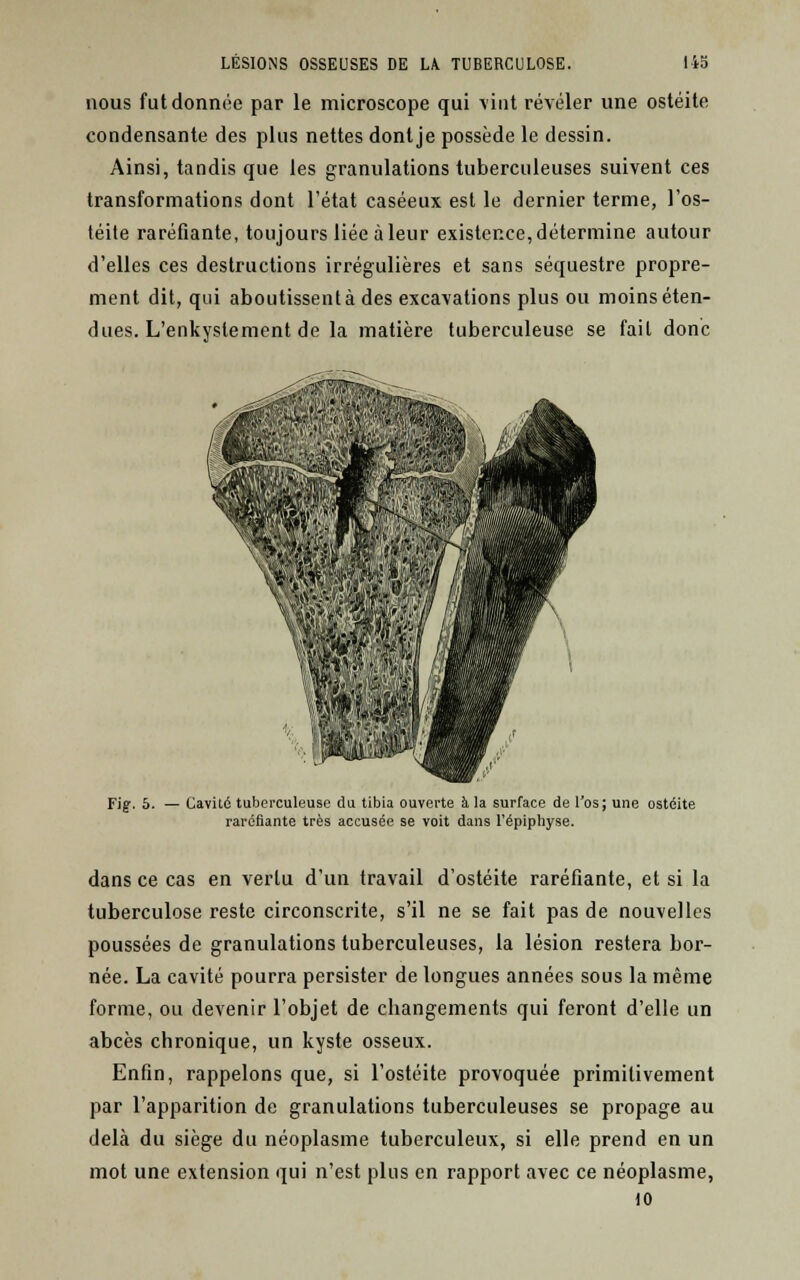 nous fut donnée par le microscope qui tint révéler une ostéite condensante des plus nettes dontje possède le dessin. Ainsi, tandis que les granulations tuberculeuses suivent ces transformations dont l'état caséeux est le dernier terme, l'os- téite raréfiante, toujours liée à leur existence, détermine autour d'elles ces destructions irrégulières et sans séquestre propre- ment dit, qui aboutissent à des excavations plus ou moins éten- dues. L'enkyslement de la matière tuberculeuse se fait donc Fig. 5. — Cavité tuberculeuse du tibia ouverte à la surface de l'os; une ostéite raréfiante très accusée se voit dans l'épiphyse. dans ce cas en vertu d'un travail d'ostéite raréfiante, et si la tuberculose reste circonscrite, s'il ne se fait pas de nouvelles poussées de granulations tuberculeuses, la lésion restera bor- née. La cavité pourra persister de longues années sous la même forme, ou devenir l'objet de changements qui feront d'elle un abcès chronique, un kyste osseux. Enfin, rappelons que, si l'ostéite provoquée primitivement par l'apparition de granulations tuberculeuses se propage au delà du siège du néoplasme tuberculeux, si elle prend en un mot une extension qui n'est plus en rapport avec ce néoplasme, 10