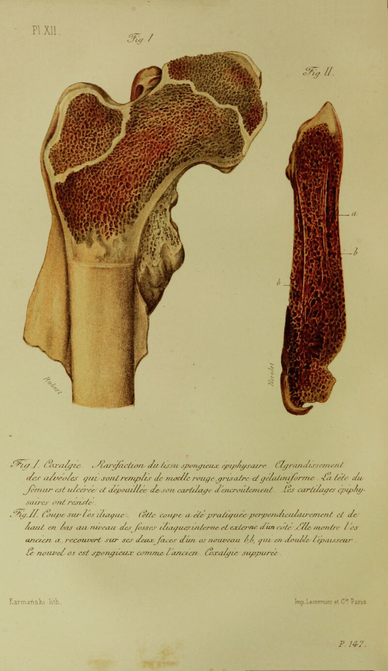 5S,/ i% II. >'^'/t/ / ( '<:i-<i/</n- ■ n'tu</(ï<-ù<>ji dùùssu spongieux. epipAgsatre Clgrandissenie.nl fiéw a/veoles t///i sontrenipus de moelle rouge,, gris aire etgreuuUnjforme <& éere du /,■//////■ est ulcérée et depouiMee. de son cartilage denerouéement Ces cartilages epipng- ■va//-c.v ont résiste ^'/'/,/.//. Coupe*sur*Lostuaçue Cette coupe n été pralzuacc perpenazcudairement et de haut en 6ns a/t ruvecui des fisses rtuzauef interne ctexterne. duncote .<//<• montre Los ancten a. recouvert sur ses deua>jàces dun os nouveau 6,6, <rui ('/< dauole l'épaisseur le nouvel/os est spongieuse cûntnze t ancien Coxalgie suppur&e • ■ ' p 14 v.