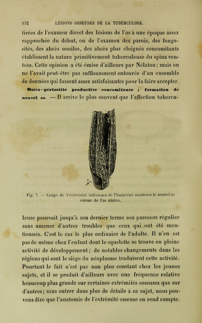 Urées de l'examen direct des lésions de l'os à une époque assez rapprochée du début, ou de l'examen des parois, des fongo- sités, des abcès sessiles, des abcès plus éloignés concomitants établissent la nature primitivement tuberculeuse du spinaven- tosa. Cette opinion a été émise d'ailleurs par Nélaton; mais on ne l'avait peut-être pas suffisamment entourée d'un ensemble de données qui fussent assez satisfaisantes pour la faire accepter. ©stéo-périostite productive concomitante ; formation aie nouvel os. — Il arrive le plus souvent que l'affection tubercu- l,-ig. 7. — Coupe de l'extrémité inférieure de l'humérus montrant le nouvel os autour de l'os ancien. leuse poursuit jusqu'à son dernier terme son parcours régulier sans amener d'autres troubles que ceux qui ont été men- tionnés. C'est le cas le plus ordinaire de l'adulte. Il n'en est pas de même chez l'enfant dont le squelette se trouve en pleine activité de développement ; de notables changements dans les régions qui sont le siège du néoplasme traduisent cette activité. Pourtant le fait n'est pas non plus constant chez les jeunes sujets, et il se produit d'ailleurs avec une fréquence relative beaucoup plus grande sur certaines extrémités osseuses que sur d'autres; sans entrer dans plus de détails à ce sujet, nous pou- vons dire que l'anatomie de l'extrémité osseuse en rend compte.