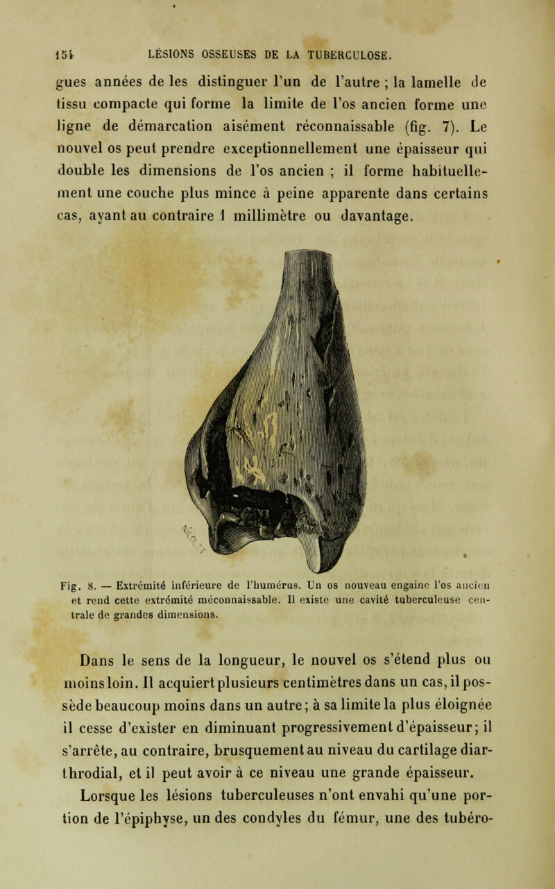 gues années de les distinguer l'un de l'autre ; la lamelle de tissu compacte qui forme la limite de l'os ancien forme une ligne de démarcation aisément réconnaissable (fig. 7). Le nouvel os peut prendre exceptionnellement une épaisseur qui double les dimensions de l'os ancien ; il forme habituelle- ment une couche plus mince a peine apparente dans certains cas, ayant au contraire 1 millimètre ou davantage. Fig. 8. — Extrémité inférieure de l'humeras. Un os nouveau engaine l'os ancien et rend cette extrémité méconnaissable. Il existe une cavité tuberculeuse cen- trale de grandes dimensions. Dans le sens de la longueur, le nouvel os s'étend plus ou moins loin. Il acquiert plusieurs centimètres dans un cas, il pos- sède beaucoup moins dans un autre ; à sa limite la plus éloignée il cesse d'exister en diminuant progressivement d'épaisseur; il s'arrête, au contraire, brusquement au niveau du cartilage diar- throdial, et il peut avoir à ce niveau une grande épaisseur. Lorsque les lésions tuberculeuses n'ont envahi qu'une por- tion de l'épiphyse, un des condyles du fémur, une des tubéro-