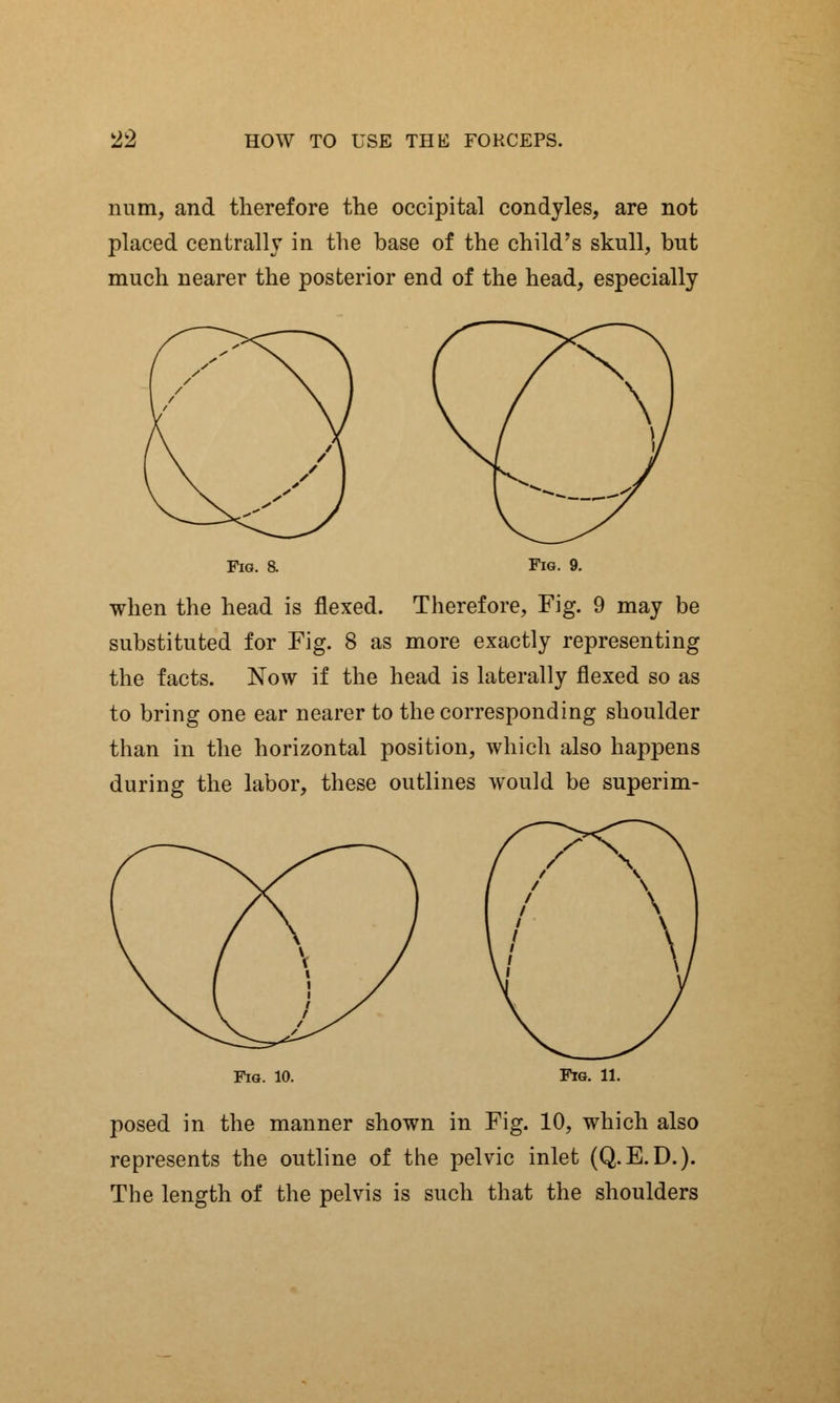 num, and therefore the occipital condyles, are not placed centrally in the base of the child's skull, but much nearer the posterior end of the head, especially Fig. a Fig. 9. when the head is flexed. Therefore, Fig. 9 may be substituted for Fig. 8 as more exactly representing the facts. Now if the head is laterally flexed so as to bring one ear nearer to the corresponding shoulder than in the horizontal position, which also happens during the labor, these outlines would be superim- Fig. 10. Fig. 11. posed in the manner shown in Fig. 10, which also represents the outline of the pelvic inlet (Q.E.D.). The length of the pelvis is such that the shoulders