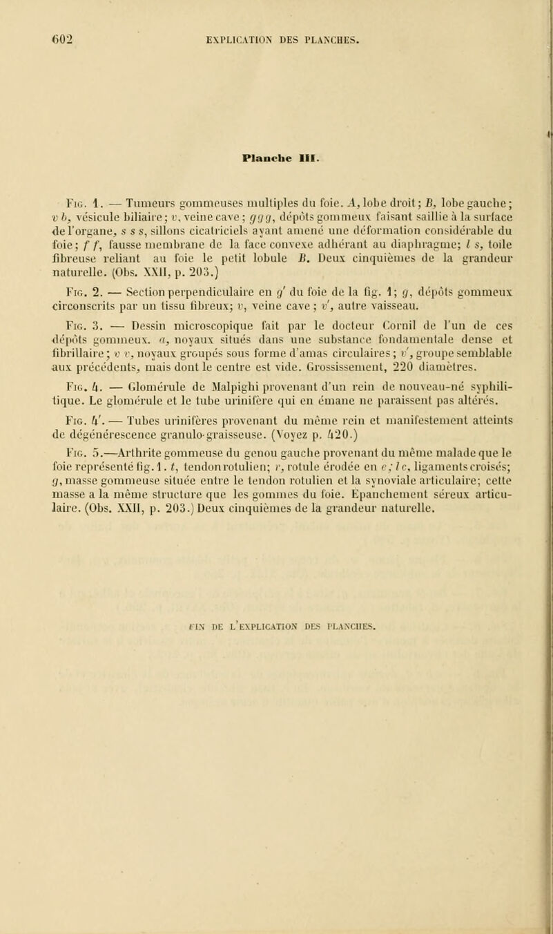 Planche III. Fig. 1. — Tumeurs gommeuses multiples du foie. A, lobe droit; B, lobe gauche; v '>, vésicule biliaire; u, veine cave ; ggg, dépôts gommeux luisant saillie à la surface de l'organe, s s s, sillons cicatriciels ayant amené une déformation considérable du foie; f f, fausse membrane de la face convexe adhérant au diaphragme; / s, toile fibreuse reliant au foie le petit lobule B. Deux cinquièmes de la grandeur naturelle. (Obs. XXII, p. 203.) Fig. 2. — Section perpendiculaire en cj du foie de la fi g. 1; </, dépôts gommeux circonscrits par un tissu fibreux; r, veine cave ; v, autre vaisseau. Fig. 3. — Dessin microscopique fait par le docteur Cornil de l'un de ces dépôts gommeux. a, noyaux situés dans une substance fondamentale dense et fibrillaire ; v r, noyaux groupés sous forme d'amas circulaires ; u', groupe semblable aux précédents, mais dont le centre est vide. Grossissement, 220 diamètres. Fig. U. —Glomérule de Malpighi provenant d'un rein de nouveau-né syphili- tique. Le glomérule et le tube urinil'ère qui en émane ne paraissent pas altérés. Fig. W. — Tubes urinileres provenant du même rein et manifestement atteints de dégénérescence granulo-graisseuse. (Voyez p. /|20.) Fig. 5.—Arthrite gommeuse du genou gauche provenant du même malade que le foie représenté fig. 1. /, tendonrotulien; r, rotule érodée en e;lc, ligaments croisés; ;/, masse gommeuse située entre le tendon rotulien el la synoviale articulaire; celte masse a la même structure que les gommes du foie. Kpanchement séreux articu- laire. (Obs. XXII, p. 203.) Deux cinquièmes de la grandeur naturelle. I IN DE I. EXPLICATION DES PLANCHES.