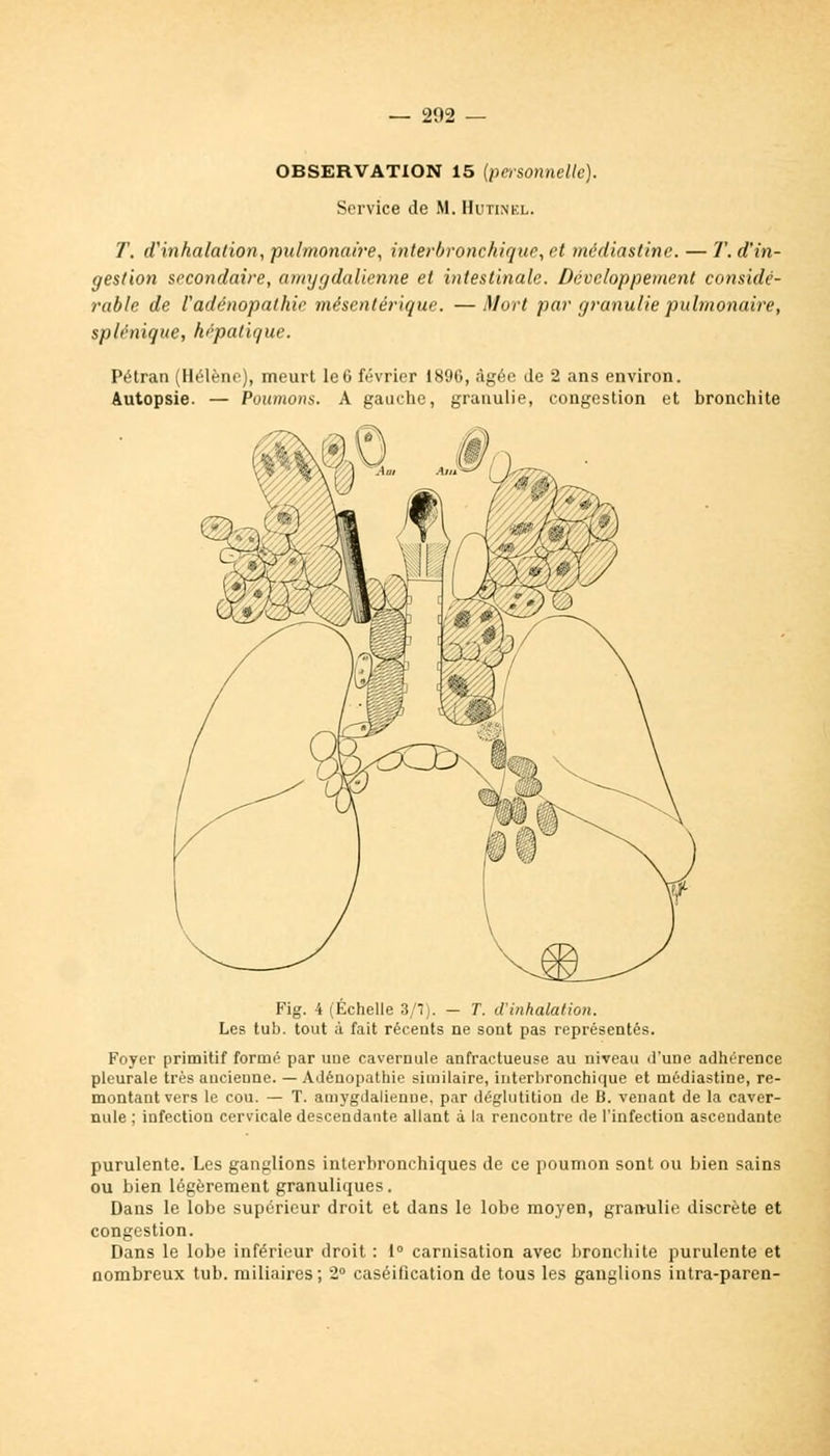 OBSERVATION 15 {personnelle). Service de M. Hutinel. T. (Vinhalation, pulmonaire, interbronchique, et médiastine. — T. d'in- gestion secondaire, amygdalienne et intestinale. Développement considé- rable de Vadénopathie mésentérique. —Mort par granulie pulmonaire, splénique, hépatique. Pétran (Hélène), meurt le6 février 1890, âgée Je 2 ans environ. Autopsie. — Poumons. A gauche, granulie, congestion et bronchite Fig. 4 (Échelle 3/7). — T. d'inhalation. Les tub. tout à fait récents ne sont pas représentés. Foyer primitif formé par une cavernule anfractueuse au niveau d'une adhérence pleurale très ancienne. — Adéuopathie similaire, interbronchique et médiastine, re- montant vers le cou. — T. amygdalienne, par déglutition de B. venaot de la caver- nule ; infection cervicale descendante allant à la rencontre de l'infection ascendante purulente. Les ganglions interbronchiques de ce poumon sont ou bien sains ou bien légèrement granuliques. Dans le lobe supérieur droit et dans le lobe moyen, granulie discrète et congestion. Dans le lobe inférieur droit : 1° carnisation avec bronchite purulente et nombreux tub. miliaires ; 2° caséilîcation de tous les ganglions intra-paren-