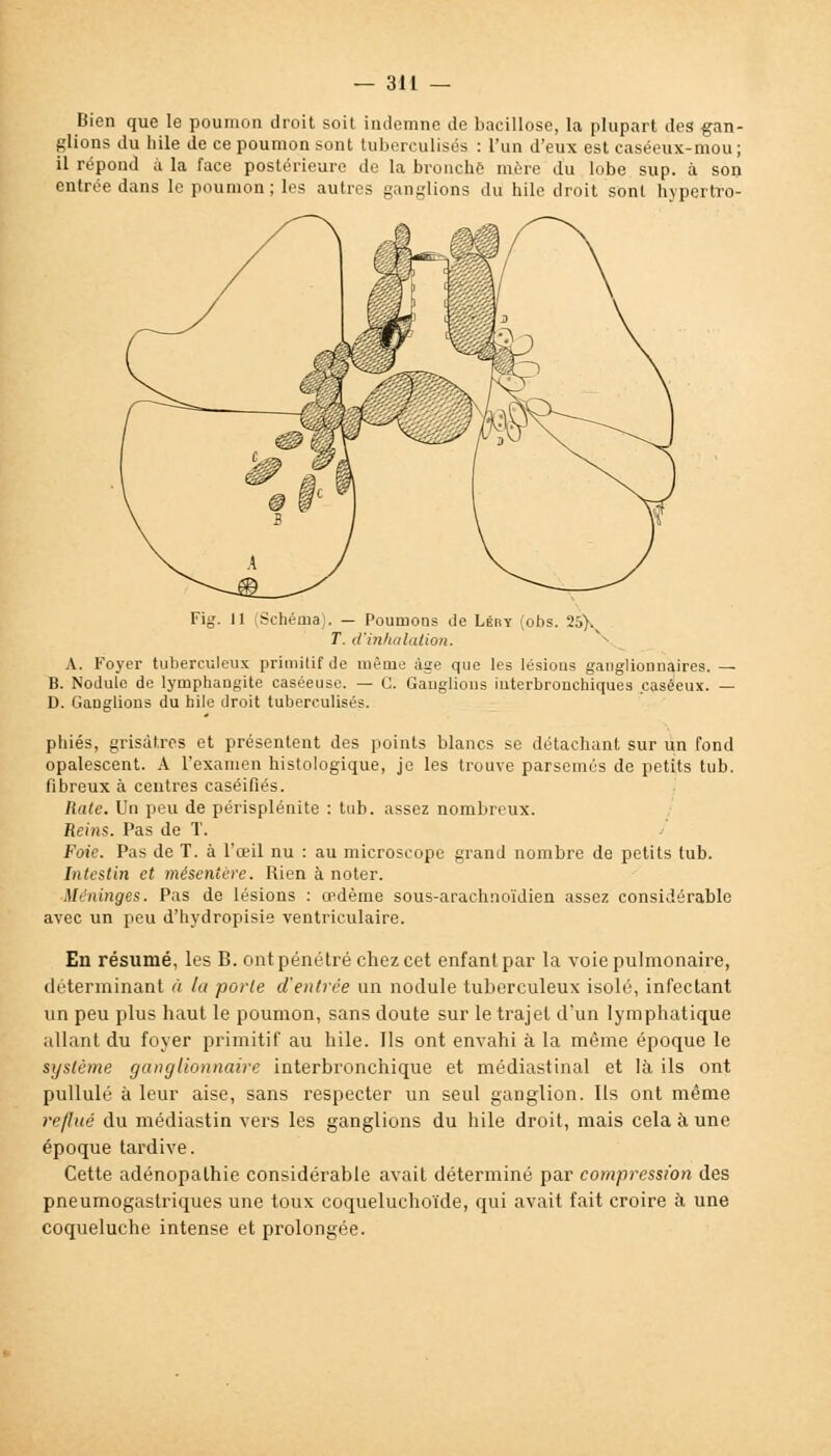 Bien que le poumon droit soit indemne de bacillose, la plupart des gan- glions du bile de ce poumon sont tubereulisés : l'un d'eux est caséeux-mou ; il répond à la face postérieure de la bronche mère du lobe sup. à son entrée dans le poumon; les autres ganglions du hile droit sont hypertro- 11 iSchéiua). — Poumons de Léhy (obs. 25% T. d'inhalation. A. Foyer tuberculeux primitif de même âge que les lésions ganglionnaires. — B. Nodule de lymphangite caséeuse. — C. Ganglions iuterbrouchiques caséeux. — D. Ganglions du hile droit tubereulisés. pbiés, grisâtres et présentent des points blancs se détachant sur un fond opalescent. A l'examen histologique, je les trouve parsemés de petits tub. fibreux à centres caséifiés. Rate. Un peu de périsplénite : tub. assez nombreux. Reins. Pas de T. Foie. Pas de T. à l'œil nu : au microscope grand nombre de petits tub. Intestin et mésentère. Rien à noter. Mrninges. Pas de lésions : œdème sous-arachnoïdien assez considérable avec un peu d'hydropisie ventriculaire. En résumé, les B. ont pénétré chez cet enfant par la voie pulmonaire, déterminant à la porte d'entrée un nodule tuberculeux isolé, infectant un peu plus haut le poumon, sans doute sur le trajet d'un lymphatique allant du foyer primitif au hile. Ils ont envahi à la même époque le système ganglionnaire interbronchique et médiastinal et là ils ont pullulé à leur aise, sans respecter un seul ganglion. Us ont même reflué du médiastin vers les ganglions du hile droit, mais cela à une époque tardive. Cette adénopalhie considérable avait déterminé par compression des pneumogastriques une toux coqueluchoïde, qui avait fait croire k une coqueluche intense et prolongée.