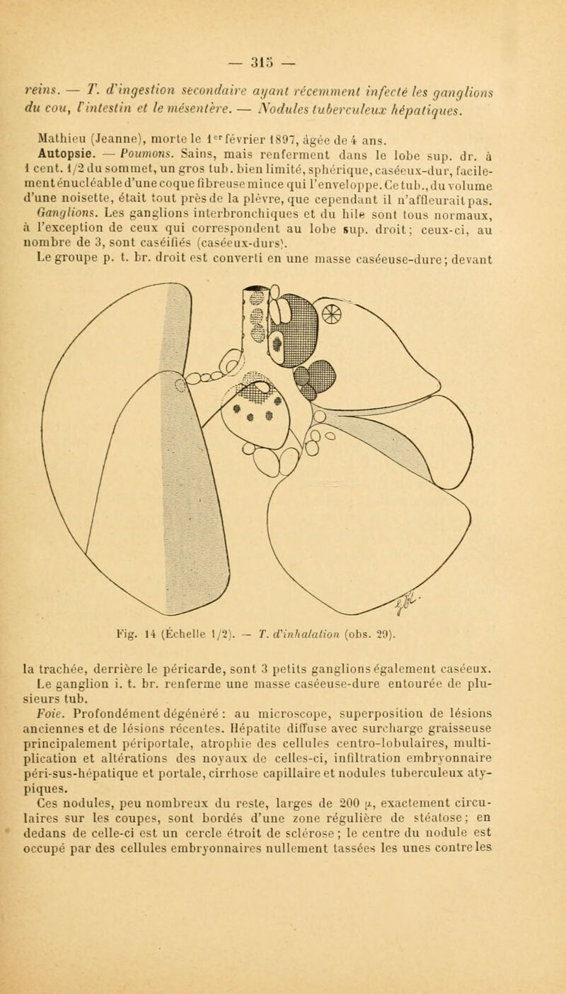 — 3i.'i — rans. — T. d'ingestion secondaire ayant récemment infecté les ganglions du cou, l'intestin et le mésentère. — Nodules tuberculeux hépatiques. Mathieu (Jeanne), morte le 1 février 1897, âgée de 4 ans. Autopsie. — Poumons. Sains, mais renferment dans le lobe sup. dr. à I cent. I 2 du sommet, un gros tub. bien limité, sphérique, caséeux-dur, facile- ment énucléable d'une coque fibreuse mince qui l'envel oppe. Ce tub., du volume d'une noisette, était tout prèsde la plèvre, que cependant il n'affleurait pas. Ganglions. Les ganglions interbronchiques et du hile sont tous normaux, à l'exception de ceux qui correspondent au lobe sup. droit; ceux-ci, au nombre de 3, sont caséifiés (caséeux-durs}. Le groupe p. t. br. droit est converti en une masse caséeuse-dure; devant Fis 14 (Echelle 1/2). - T. d'inhalation (obs. 29). la trachée, derrière le péricarde, sont 3 petits ganglions également caséeux. Le ganglion i. t. br. renferme une masse caséeuse-dure entourée de plu- sieurs tub. Foie. Profondément dégénéré : au microscope, superposition de lésions anciennes et de lésions récentes. Hépatite diffuse avec surcharge graisseuse principalement périportale, atrophie des cellules centro-lobulaires, multi- plication et altérations des noyaux de celles-ci, infiltration embryonnaire péri-sus-hépatique et portale, cirrhose capillaire et nodules tuberculeux aty- piques. Ces nodules, peu nombreux du reste, larges de 200 u, exactement circu- laires sur les coupes, sont bordés d'une zone régulière de stéatose; en dedans de celle-ci est un cercle étroit de sclérose ; le centre du nodule est occupé par des cellules embryonnaires nullement tassées les unes contrôles