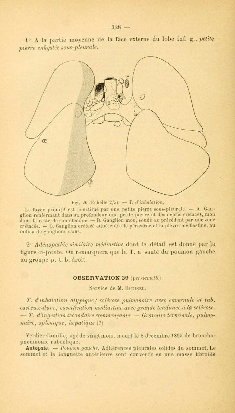 1° A la partie moyenne de la face externe du lobe inf. g., petite pierre enkystée sous-pleurale. Fig. 20 (Échelle 2/5). — T. d'inhalation. Le foyer primitif est constitué par une petite pierre sous-pleurale. — .V. Gan- glion renfermant dans sa profondeur une petite pierre et des débris crétacés, mou dans le reste de son étendue. — B. Gauglion mou, soudé au précédent par une zone crétacée. — C. Ganglion crétacé situé eutre le péricarde et la plèvre médiastine, au milieu de ganglions sains. 2° Adénopathie similaire médiastine dont le détail est donné par la figure ci-jointe. On remarquera que la T. a sauté du poumon gaurhr au groupe p. t. b. droit. OBSERVATION 39 personnelle . Service de M. Hltinel. T. d'inhalation atypique; sclérose pulmonaire avec cavernule et tub. caséeux-durs ; caséification médiastine avec grande tendance à la sclérose. — T. d'ingestion secondaire commençante. — Granulie terminale, pulmo- naire, splénique, hépatique (?) Verdier Camille, âgé de vingt mois, meurt le 8 décembre 189o de broncho- pneumonie rubéolique. Autopsie. — Poumon gauche. Adhérences pleurales solides du sommet. Le sommet et la languette antérieure sont convertis en une masse fibroïde