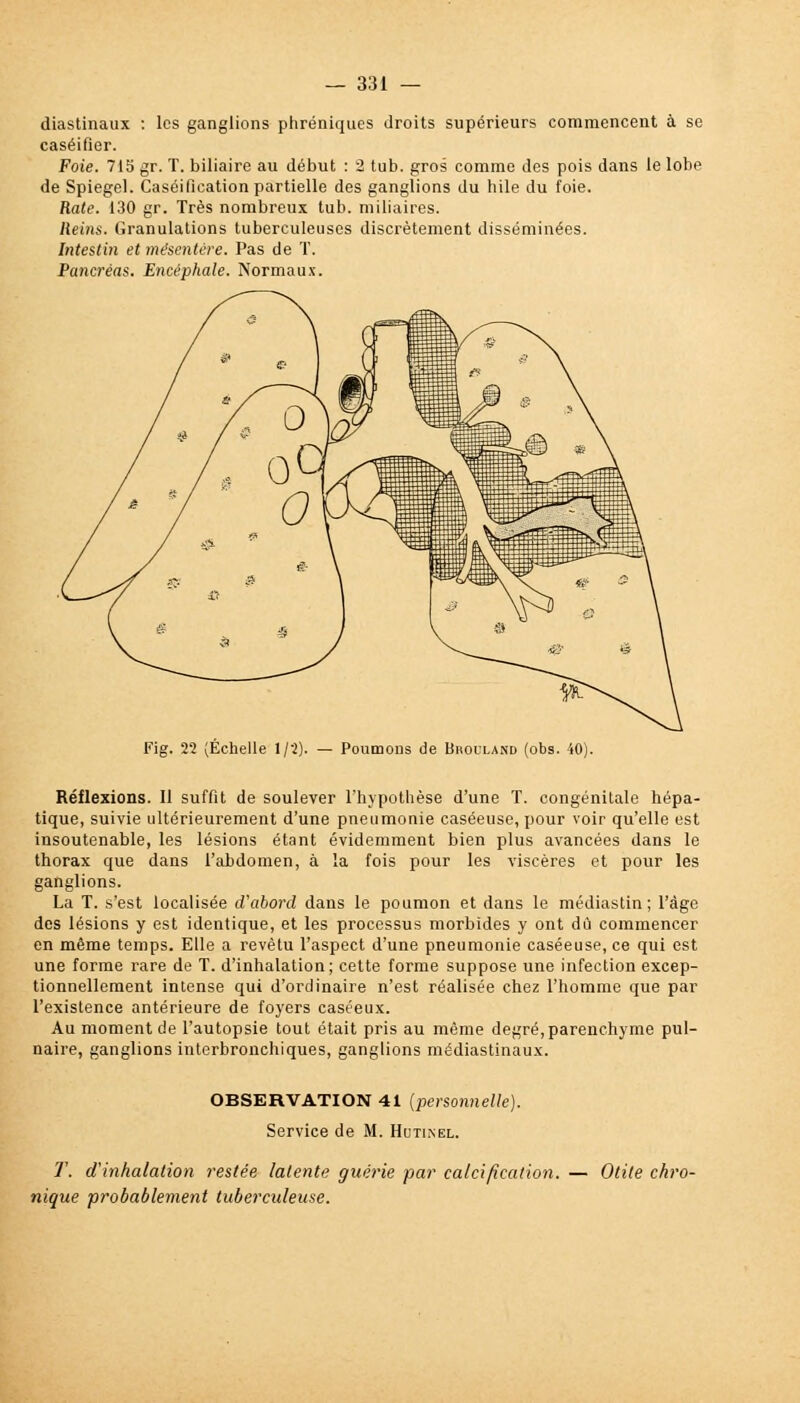 diastinaux : les ganglions phréniques droits supérieurs commencent à se caséifier. Foie. 715 gr. T. biliaire au début : 2 tub. gros comme des pois dans le lobe de Spiegel. Caséifieation partielle des ganglions du hile du foie. Rate. 130 gr. Très nombreux tub. miliaires. Reins. Granulations tuberculeuses discrètement disséminées. Intestin et mésentère. Pas de T. Pancréas. Encéphale. Normaux. Fig. 22 (Échelle 1/2). — Poumons de Uhouland (obs. 40). Réflexions. 11 suffit de soulever l'hypothèse d'une T. congénitale hépa- tique, suivie ultérieurement d'une pneumonie caséeuse, pour voir qu'elle est insoutenable, les lésions étant évidemment bien plus avancées dans le thorax que dans l'abdomen, à la fois pour les viscères et pour les ganglions. La T. s'est localisée d'abord dans le poumon et dans le médiastin; l'âge des lésions y est identique, et les processus morbides y ont dû commencer en même temps. Elle a revêtu l'aspect d'une pneumonie caséeuse, ce qui est une forme rare de T. d'inhalation; cette forme suppose une infection excep- tionnellement intense qui d'ordinaire n'est réalisée chez l'homme que par l'existence antérieure de foyers caséeux. Au moment de l'autopsie tout était pris au même degré,parenchyme pul- naire, ganglions interbronchiques, ganglions médiastinaux. OBSERVATION 41 (personnelle). Service de M. Hutikel. T. d'inhalation restée latente guérie par calcification. — Otite chro- nique probablement tuberculeuse.