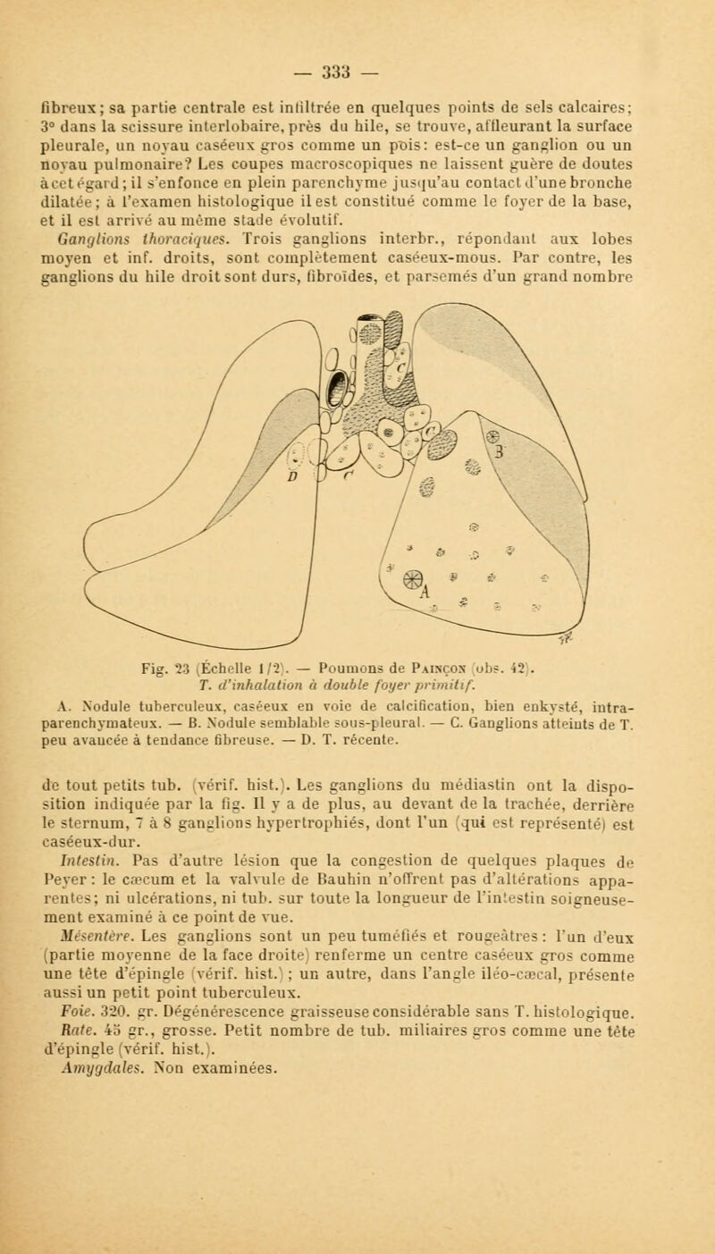 fibreux; sa partie centrale est inliltrée en quelques points de sels calcaires; 3° dans la scissure interlobaire, près du hile, se trouve, affleurant la surface pleurale, un noyau caséeux gros comme un pttis: est-ce un ganglion ou un novau pulmonaire? Les coupes macroscopiques ne laissent guère de doutes à cet égard; il s'enfonce en plein parenchyme jusqu'au contact d'une bronche dilatée; à l'examen histologique il est constitué comme le foyer de la base, et il est arrivé au même stade évolutif. Ganglions thoraciques. Trois ganglions interbr., répondant aux lobes moyen et inf. droits, sont complètement caséeux-mous. Par contre, les ganglions du hile droit sont durs, libroïdes, et parsemés d'un grand nombre Fig. 23 (Échelle 1/2). — Poumons de Painçox ubs. il . T. d'inhalation à double foyer primitif. A. Nodule tuberculeux, caséeux en voie de calcification, bien enkysté, intra- parenchymateux. — B. Nodule semblable sous-pleural. — C. Ganglions atteints de T. peu avancée à tendance fibreuse. — D. T. récente. de tout petits tub. (vérif. hist.). Les ganglions du médiastin ont la dispo- sition indiquée par la fig. Il y a de plus, au devant de la trachée, derrière le sternum, 7 à 8 ganglions hypertrophiés, dont l'un (qui est représenté) est caséeux-dur. Intestin. Pas d'autre lésion que la congestion de quelques plaques de Peyer: le cœcum et la valvule de Bauhin n'offrent pas d'altérations appa- rentes; ni ulcérations, ni tub. sur toute la longueur de l'intestin soigneuse- ment examiné à ce point de vue. Mésentère. Les ganglions sont un peu tuméfiés et rougeàtres : l'un d'eux (partie moyenne de la face droite) renferme un centre caséeux gros comme une tète d'épingle (vérif. hist.1 ; un autre, dans l'angle iléo-cœcal, présente aussi un petit point tuberculeux. Foie. 320. gr. Dégénérescence graisseuse considérable sans T. histologique. Rate. 4o gr., grosse. Petit nombre de tub. miliaires gros comme une tête d'épingle (vérif. hist.). Amygdales. Non examinées.