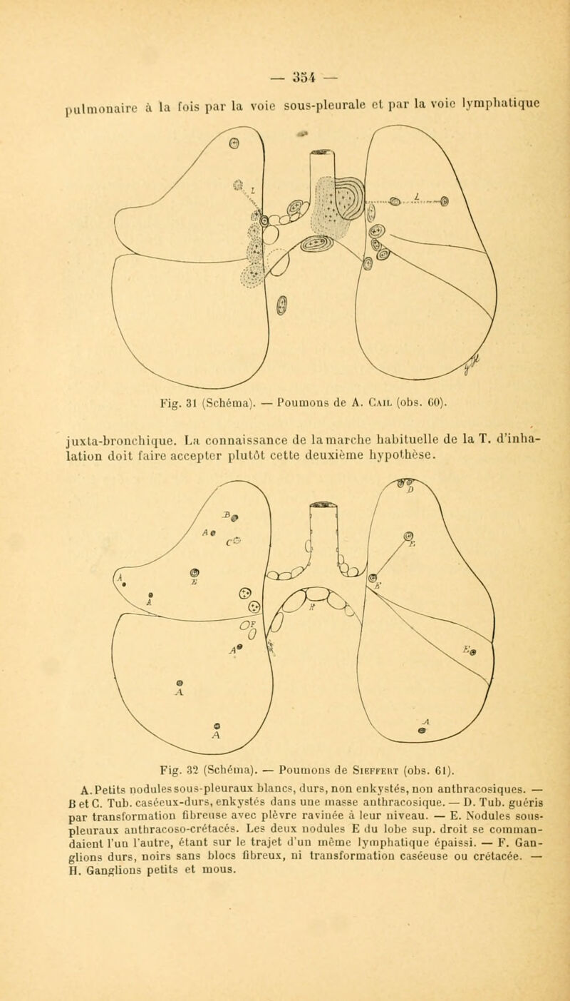 pulmonaire à la fois par la voie sous-pleurale et par la voie lymphatique Fig. 31 (Schéma). — Poumons de A. Cail (obs. CO). juxta-bronchique. La connaissance de la marche habituelle de la T. d'inha- lation doit faire accepter plutôt cette deuxième hypothèse. Fig. 32 (Schéma). — Poumous de Siefkeut (obs. Gl). A. Petits nodules sous-pleuraux blancs, durs, non enkystés, non anthracosiques. — B et C. Tub. caséeux-durs, enkystés dans une masse authracosique. — D. Tub. guéris par transformation fibreuse avec plèvre ravinée à leur niveau. — E. Nodules sous- pleuraux anthracoso-crétacés. Les deux nodules E du lobe sup. droit se comman- daient l'un l'autre, étant sur le trajet d'un même lymphatique épaissi. — F. Gan- glions durs, noirs sans blocs fibreux, ni transformation caséeuse ou crétacée. — H. Ganglions petits et mous.