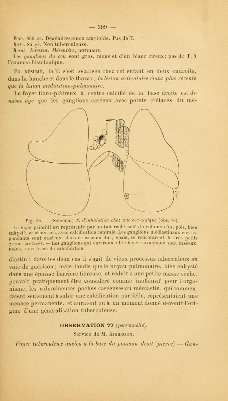 Foie. 860 gr. Dégénérescence amyloîde. Pas do T. Rate. 83 gr. Non tuberculeuse. Reins. Intestin. Mésentère, normaux. Les ganglions du cou sont gros, mous et d'un blanc cireux; pas de T. à l'examen histologique. En résdmé, la T. s'est localisée chez cet enfant en deux endroits, dans la hanche et dans le thorax, la lésion articulaire étant plu* récente que la lésion médiastino-pulmonaire. Le foyer fihro-plàtreux à rentre calcifié de la base droite est du même àye que les ganglions caséeux avec points crétacés du nié- Fig. 34. — (Schéma.) T. d'inhalation chez une eoxatgique (obs. 76). Le foyer primitif est représenté par uu tubercule isolé du volume d'un pois, bieD enkysté, caséeux, sec, avec calcification centrale. Les ganglioDs médiastinaux corres- pondants sont caséeux: dans ce caséum dur. épais, se rencontrent de très petits grains crétacés. —Les ganglions qui environnent te foyer eoxatgique sont caséeux, mous, sans trace de calcification. diastin ; dans les deux cas il s'agit de vieux processus tuberculeux en voie de guérison; mais tandis que le noyau pulmonaire, bien enkysté dans une épaisse barrière fibreuse, et réduit aune petite masse sèche, pouvait pratiquement être considéré comme inoffensif pour l'orga- nisme, les volumineuses poches caséeusesdu médiastin, qui commen- çaient seulement à subir une calcification partielle, représentaient une menace permanente, et auraient pu à un moment donné devenir l'ori- gine d'une généralisation tuberculeuse. OBSERVATION 77 [personnelle). Service de M. Kirsiisson. Foyer tuberculeux ancien à lu base du poumon droit [pierre) — Gan-