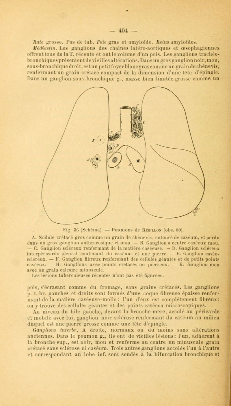 Rate grosse. Pas île tuh. Fuie gras et amyloîde. Reins amyloïdes. i/r tiastin. Les ganglions des chaînes latéro-aorliques et œsophagiennes offrent tous de la T. récente et ont le volume d'un pois. Les ganglions trachéo- bronchiquesprésententdevieillesaltérations.Dansun gros ganglion noir, mon, sous-bronchique droit, esl un petit f< ijer blanc gros comme un grain de chènevi?, renfermant un grain crétacé compact de la < 1 i osion d'une tête d'épingle. Dans un ganglion sous-bronchique g., masse bien limitée grosse comme un Fi::. 36 Schéma). — Poumons de Rébillon (obs. 80). A. Nodule crétacé gros comme un grain de chènevis. entouré de caséum, et perdu dans un gros ganglion anthracosique et mou. — B. Ganglion à centre caséeux mou. — C. Ganglion scléreux renfermant de la matière caséeuse. — D. Ganglion scléreux interpérieardo-pleural contenant du caséum et une pierre. — E. Ganglion caséo- scléreux. — F. Ganglion fibreux renfermant des cellules géantes et de petits points caséeux. — H Ganglions avec poiuts crétacés ou pierreux. — K. Ganglion mou avec un grain calcaire minuscule. Les lésinns tuberculeuses récentes n'ont pas été figurées. pois, s'écrasant comme du fromage, sans grains crétacés. Les ganglions p. t. br. gauches et droits sont formés d'une coque fibreuse épaisse renfer- mant de la matière caséeuse-molle : l'un d'eux est complètement fibreux: on y trouve des cellules géantes et des points caséeux microscopiques. Au niveau du bile gauche, devant la bronche mère, accolé au péricarde et mobile avec lui, ganglion noir sclérosé renfermant du caséum au milieu duquel est une pierre grosse comme une tète d'épingle. Ganglion? interbr. A droite, normaux ou du moins sans altérations anciennes. Dans le poumon g., ils ont de vieilles lésions: l'un, adhérent à la bronche sup., est noir, mou et renferme au centre un minuscule grain crétacé sans sclérose ni caséum. Trois autres ganglions accolés l'un à l'autre et correspondant au lobe inf. sont soudés à la bifurcation bronchique et