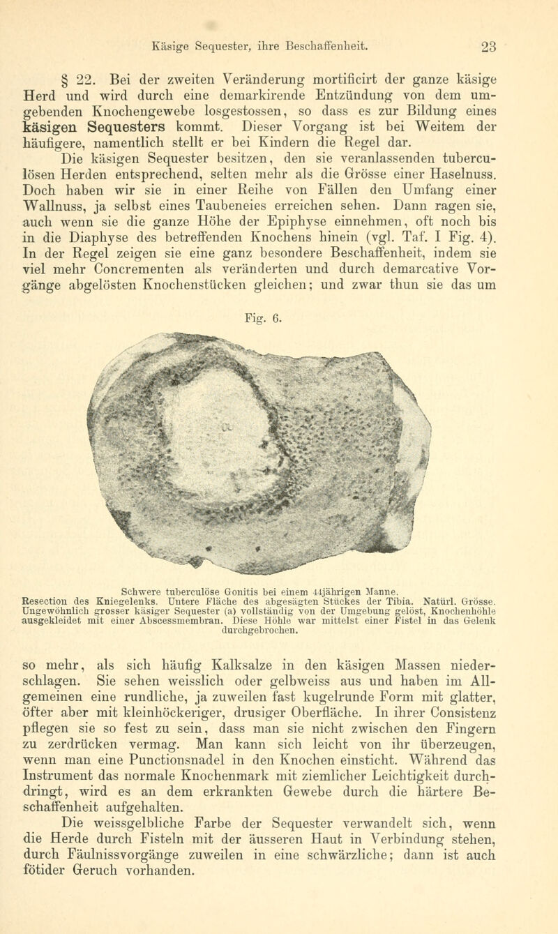 § 22. Bei der zweiten Veränderung mortificirt der ganze käsige Herd und wird durch eine demarkirende Entzündung von dem um- gebenden Knochengewebe losgestossen, so dass es zur Bildung eines käsigen Sequesters kommt. Dieser Vorgang ist bei Weitem der häufigere, namentlich stellt er bei Kindern die Regel dar. Die käsigen Sequester besitzen, den sie veranlassenden tubercu- lösen Herden entsprechend, selten mehr als die Grösse einer Haselnuss. Doch haben wir sie in einer Reihe von Fällen den Umfang einer Wallnuss, ja selbst eines Taubeneies erreichen sehen. Dann ragen sie, auch wenn sie die ganze Höhe der Epiphyse einnehmen, oft noch bis in die Diaphyse des betreffenden Knochens hinein (vgl. Taf. I Fig. 4). In der Regel zeigen sie eine ganz besondere Beschaffenheit, indem sie viel mehr Concrementen als veränderten und durch demarcative Vor- gänge abgelösten Knochenstücken gleichen; und zwar thun sie das um Fig. 6. Schwere tuberculöse Gonitis bei einem Ujährigen Manne. Resection des Kniegelenks. Untere Fläche des abgesägten Stückes der Tibia. Natürl. Grösse. Ungewöhnlich grosser käsiger Sequester (a) vollständig von der Umgebung gelöst, Knochenhöhle ausgekleidet mit einer Abscessmembran. Diese Höhle war mittelst einer Fistel in das Gelenk durchgebrochen. so mehr, als sich häufig Kalksalze in den käsigen Massen nieder- schlagen. Sie sehen weisslich oder gelbweiss aus und haben im All- gemeinen eine rundliche, ja zuweilen fast kugelrunde Form mit glatter, öfter aber mit kleinhöckeriger, drusiger Oberfläche. In ihrer Consistenz pflegen sie so fest zu sein, dass man sie nicht zwischen den Fingern zu zerdrücken vermag. Man kann sich leicht von ihr überzeugen, wenn man eine Punctionsnadel in den Knochen einsticht. Während das Instrument das normale Knochenmark mit ziemlicher Leichtigkeit durch- dringt, wird es an dem erkrankten Gewebe durch die härtere Be- schaffenheit aufgehalten. Die weissgelbliche Farbe der Sequester verwandelt sich, wenn die Herde durch Fisteln mit der äusseren Haut in Verbindung stehen, durch Fäulnissvorgänge zuweilen in eine schwärzliche; dann ist auch fötider Geruch vorhanden.