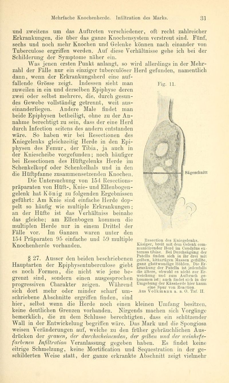 Fi«-. 11. und zweitens um das Auftreten verschiedener, oft recht zahlreicher Erkrankungen, die über das ganze Knochensystem verstreut sind. Fünf, sechs und noch mehr Knochen und Gelenke können nach einander von Tuberculose ergriffen werden. Auf diese Verhältnisse gehe ich bei der Schilderung der Symptome näher ein. Was jenen ersten Punkt anlangt, so wird allerdings in der Mehr- zahl der Fälle nur ein einziger tuberculöser Herd gefunden, namentlich dann, wenn der Erkrankungsherd eine auf- fallende Grösse zeigt. Indessen sieht man zuweilen in ein und derselben Epiphyse deren zwei oder selbst mehrere, die, durch gesun- des Gewebe vollständig getrennt, weit aus- einanderliegen. Andere Male findet man beide Epiphysen betheiligt, ohne zu der An- nahme berechtigt zu sein, dass der eine Herd durch Infection seitens des andern entstanden wäre. So haben wir bei Resectionen des Kniegelenks gleichzeitig Herde in den Epi- physen des Femur, der Tibia, ja auch in der Kniescheibe vorgefunden; noch häufiger bei Resectionen des Hüftgelenks Herde im Schenkelkopf oder Schenkelhals und in den die Hüftpfanne zusammensetzenden Knochen. Die Untersuchung von 154 Resections- präparaten von Hüft-, Knie- und Ellenbogen- gelenk hat König zu folgenden Ergebnissen geführt: Am Knie sind einfache Herde dop- pelt so häufig wie multiple Erkrankungen; an der Hüfte ist das Verhältniss beinahe das gleiche; am Ellenbogen kommen die multiplen Herde nur in einem Drittel der Fälle vor. Im Ganzen waren unter den 154 Präparaten 95 einfache und 59 multiple Knochenherde vorhanden. I «SBR»fY8*jafliftiRt,Sa!LWB;?»'M<i;Ä--rt.ri Sägeschnitt 7 \ § 27. Ausser den beiden beschriebenen Resection des Kniegelenks. Käsiger, breit mit dem Gelenk com- municirender Herd im Condylus ex- ternus tibiae. Bei Durchsägung der Patella finden sich in ihr drei mit elben, kittartigen Massen gefüllte, Hauptarten der Epiphysentuberculose giebt frankun^&p^iSftat™. B jedenfalls die ältere, obwohl es nicht zur Er- weichung und zum Aufbruch ge- kommen ist; auch findet sich in der Umgebung der Käseherde hier kaum eine Spur von Reaction. Aus Volkmann a. a. 0. Taf. II. kleinen Umfang besitzen, es noch Formen, die nicht wie jene be- grenzt sind, sondern einen ausgesprochen progressiven Charakter zeigen. Während sich dort mehr oder minder scharf um- schriebene Abschnitte ergriffen finden, sind hier, selbst wenn die Herde noch einen keine deutlichen Grenzen vorhanden. Nirgends machen sich Vorgänge bemerklich, die zu dem Schlüsse berechtigten, dass ein schützender Wall in der Entwickelung begriffen wäre. Das Mark und die Spongiosa weisen Veränderungen auf, welche zu den früher gebräuchlichen Aus- drücken der grauen, der durchscheinenden, der gelben und der weinhefe- farbenen Infiltration Veranlassung gegeben haben. Es findet keine eitrige Schmelzung, keine Mortification und Sequestration in der ge- schilderten Weise statt, der ganze erkrankte Abschnitt zeigt vielmehr