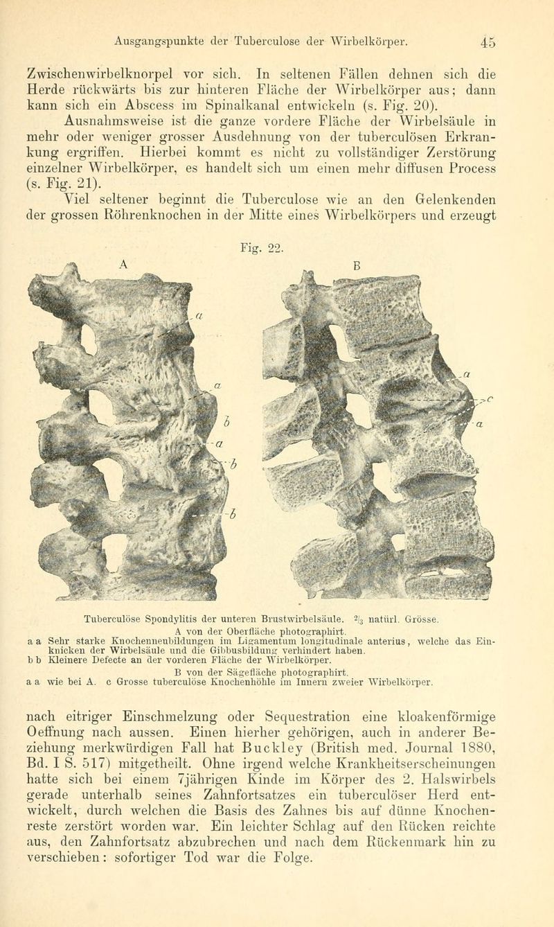Zwischenwirbelkuorpel vor sich. In seltenen Fällen dehnen sich die Herde rückwärts bis zur hinteren Fläche der Wirbelkörper aus; dann kann sich ein Abscess im Spinalkanal entwickeln (s. Fig. 20). Ausnahmsweise ist die ganze vordere Fläche der Wirbelsäule in mehr oder weniger grosser Ausdehnung von der tuberculösen Erkran- kung ergriffen. Hierbei kommt es nicht zu vollständiger Zerstörung einzelner Wirbelkörper, es handelt sich um einen mehr diffusen Process (s. Fig. 21). Viel seltener beginnt die Tuberculose wie an den Gelenkenden der grossen Röhrenknochen in der Mitte eines Wirbelkörpers und erzeugt Fig. 22. Tuberculose Spondylitis der unteren Brustwirbelsäule. 2/3 natürl. Grösse. A von der Oberfläche photographirt. aa Sehr starke Knochemieubildungen im Ligamentum longitudinale anterius, welche das Ein- knicken der Wirbelsäule und die Gibbusbildung verhindert haben. b b Kleinere Defecte an der vorderen Fläche der Wirbelkörper. B von der Sägefläche photographirt. a a wie bei A. c Grosse tuberculose Knochenhöhle im Innern zweier Wirbelkörper. nach eitriger Einschmelzung oder Sequestration eine kloakenförmige Oeffnung nach aussen. Einen hierher gehörigen, auch in anderer Be- ziehung merkwürdigen Fall hat Buckley (British med. Journal 1880, Bd. I S. 517) mitgetheilt. Ohne irgend welche Krankheitserscheinungen hatte sich bei einem 7jährigen Kinde im Körper des 2. Halswirbels gerade unterhalb seines Zahnfortsatzes ein tuberculöser Herd ent- wickelt, durch welchen die Basis des Zahnes bis auf dünne Knochen- reste zerstört worden war. Ein leichter Schlag auf den Rücken reichte aus, den Zahnfortsatz abzubrechen und nach dem Rückenmark hin zu verschieben: sofortiger Tod war die Folge.