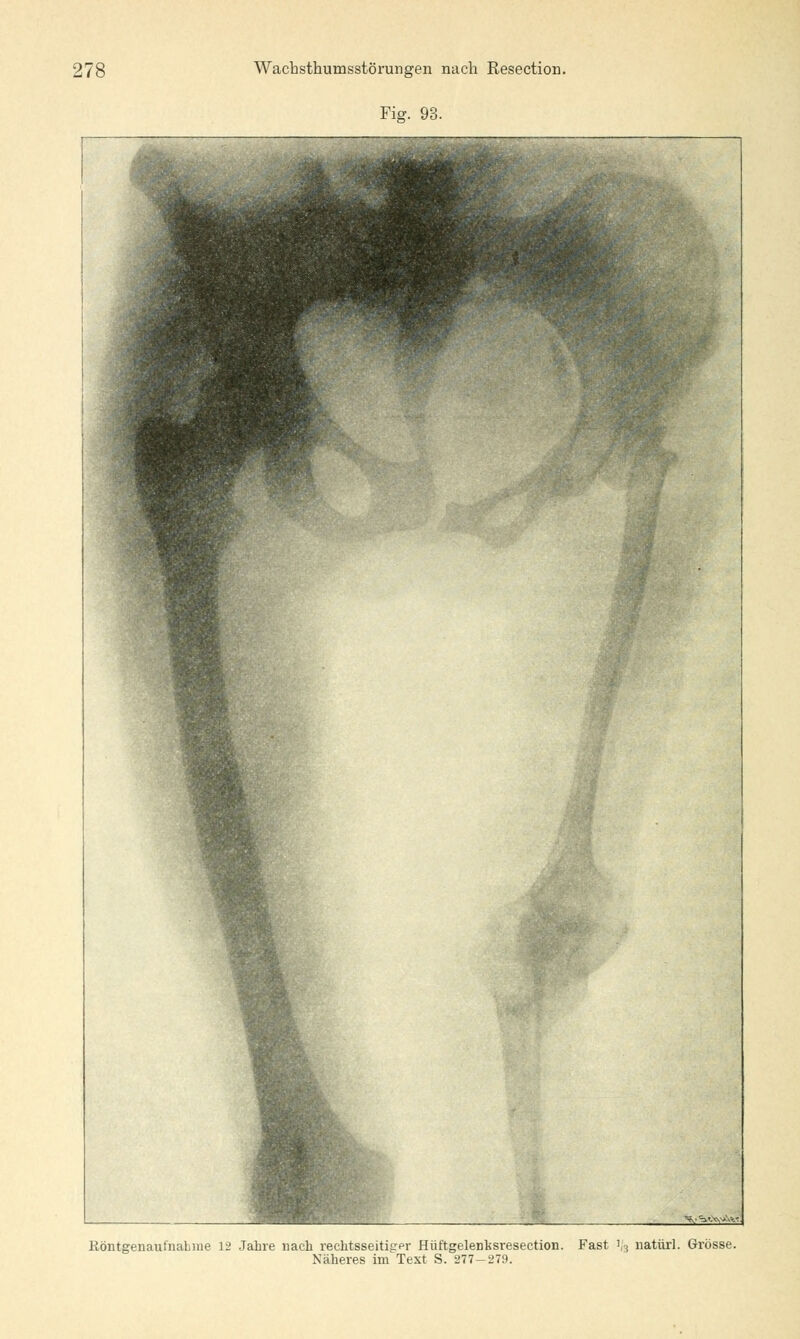 Fig. 93. Röntgenaufnahme 12 Jahre nach rechtsseitiger Hüftgelenksresection. Fast ife natürl. Grösse. Näheres im Text S. 277-279.