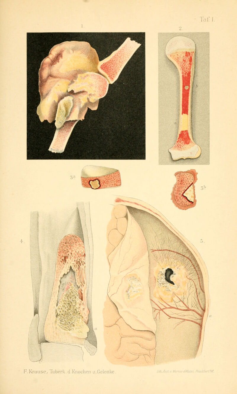 F.Krause, Tuberk.d. Knochen u.Gelenke