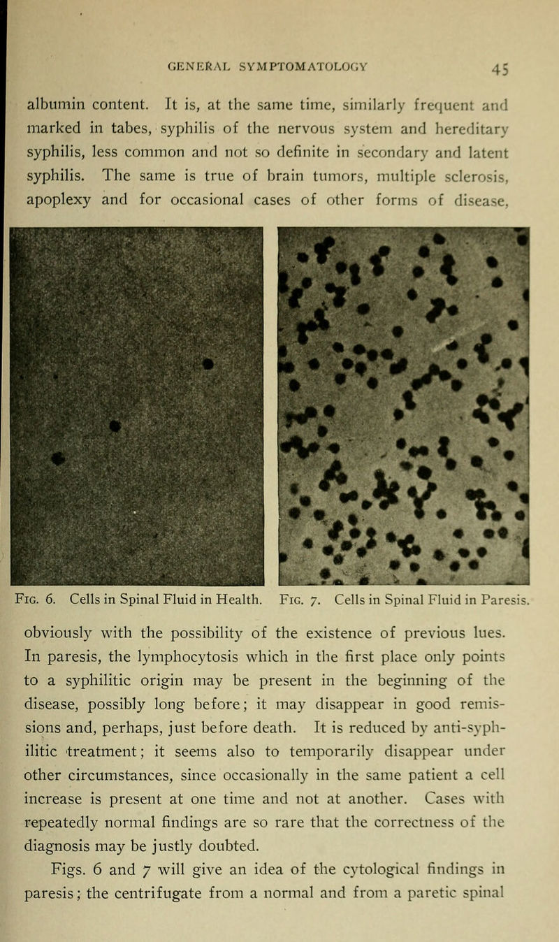 albumin content. It is, at the same time, similarly frequent and marked in tabes, syphilis of the nervous system and hereditary syphilis, less common and not so definite in secondary and latent syphilis. The same is true of brain tumors, multiple sclerosis, apoplexy and for occasional cases of other forms of disease, Fig. 6. Cells in Spinal Fluid in Health. Fig. 7. Cells in Spinal Fluid in Pare obviously with the possibility of the existence of previous lues. In paresis, the lymphocytosis which in the first place only points to a syphilitic origin may be present in the beginning of the disease, possibly long before; it may disappear in good remis- sions and, perhaps, just before death. It is reduced by anti-syph- ilitic 'treatment; it seems also to temporarily disappear under other circumstances, since occasionally in the same patient a cell increase is present at one time and not at another. Cases with repeatedly normal findings are so rare that the correctness of the diagnosis may be justly doubted. Figs. 6 and 7 will give an idea of the cytological findings in paresis; the centrifugate from a normal and from a paretic spinal